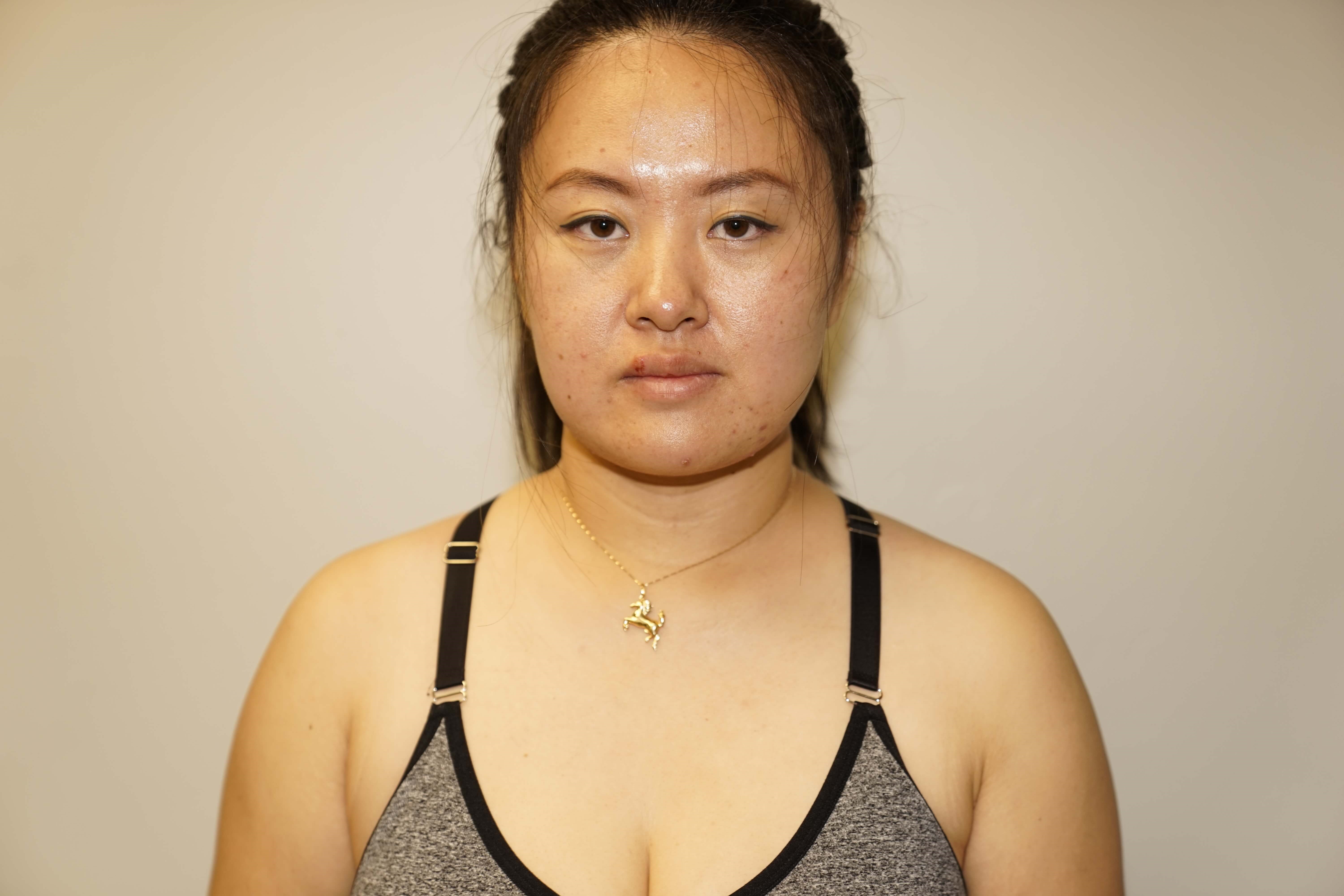 Woman has Neck Liposuction After