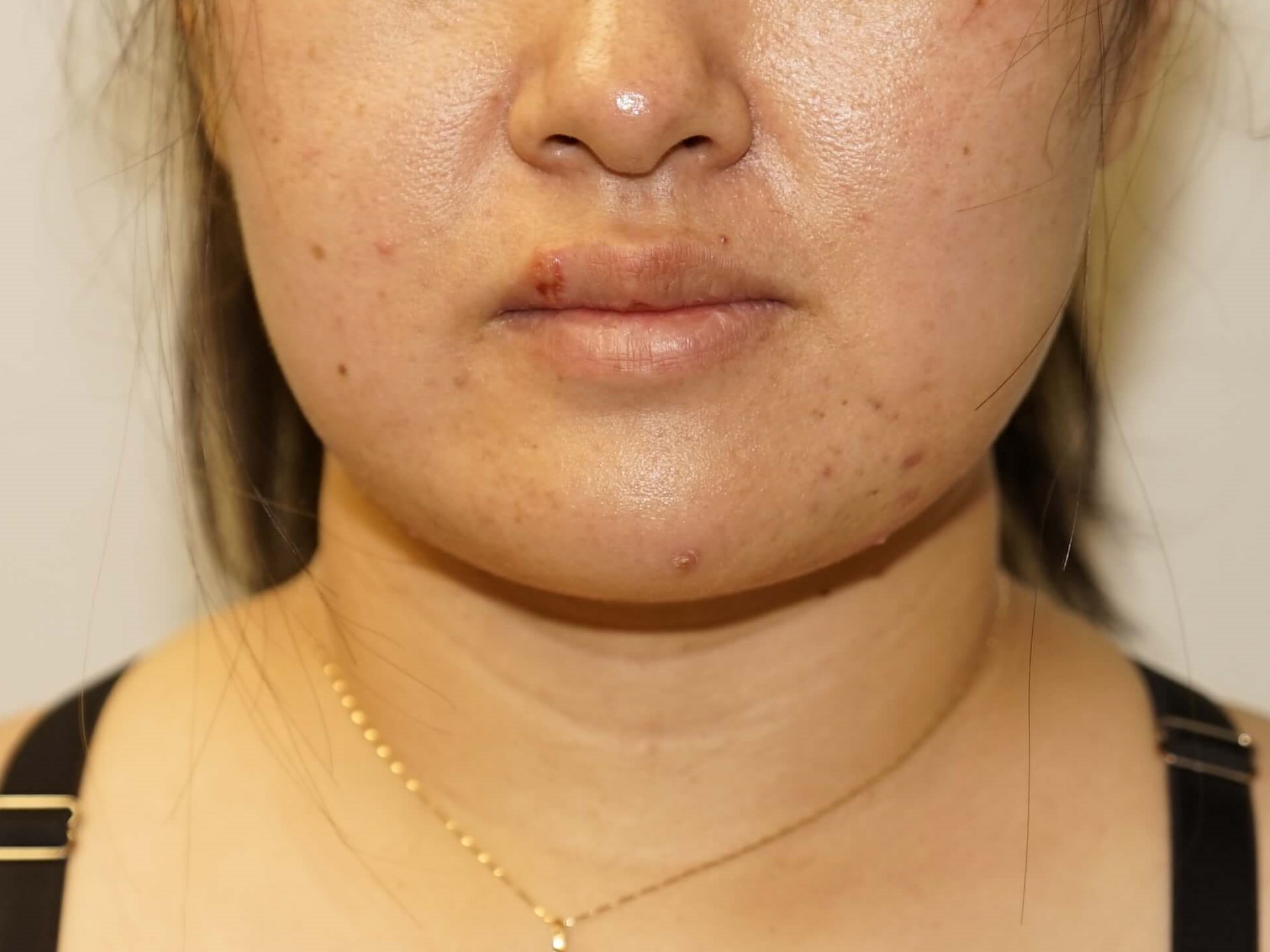 Woman has Neck Liposuction After