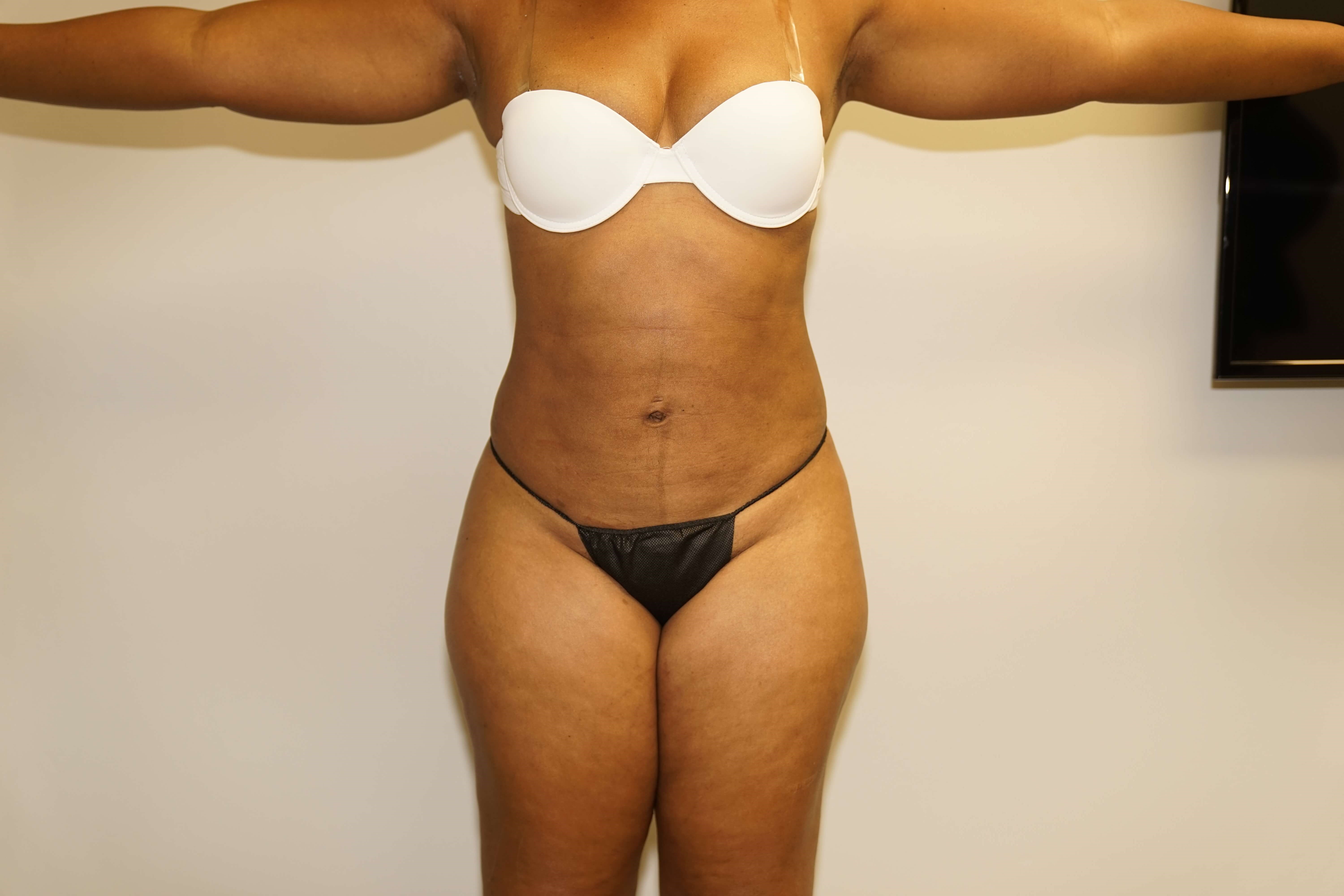 Westlake Woman Has Liposuction After