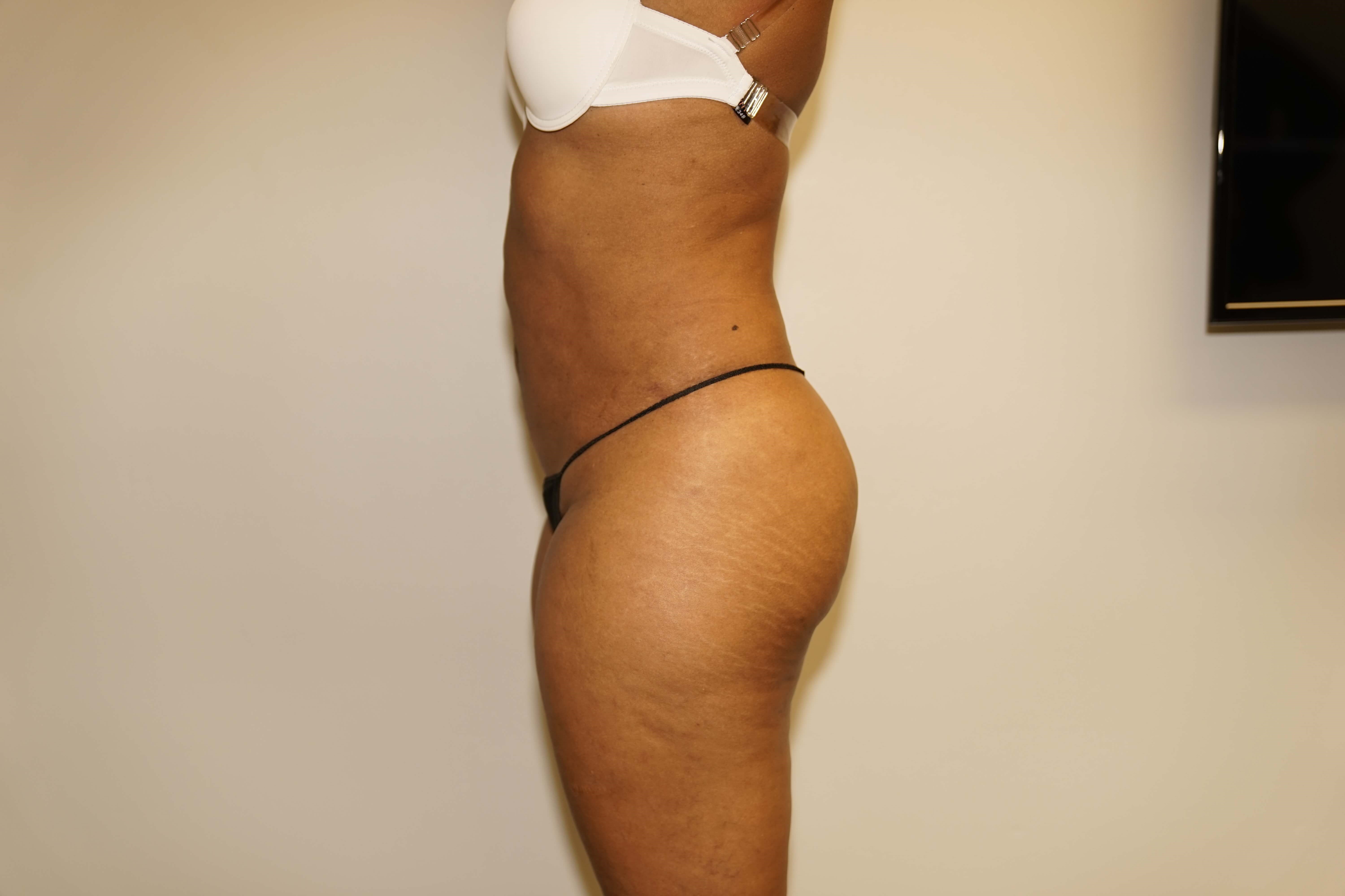 Westlake Woman Has Liposuction After