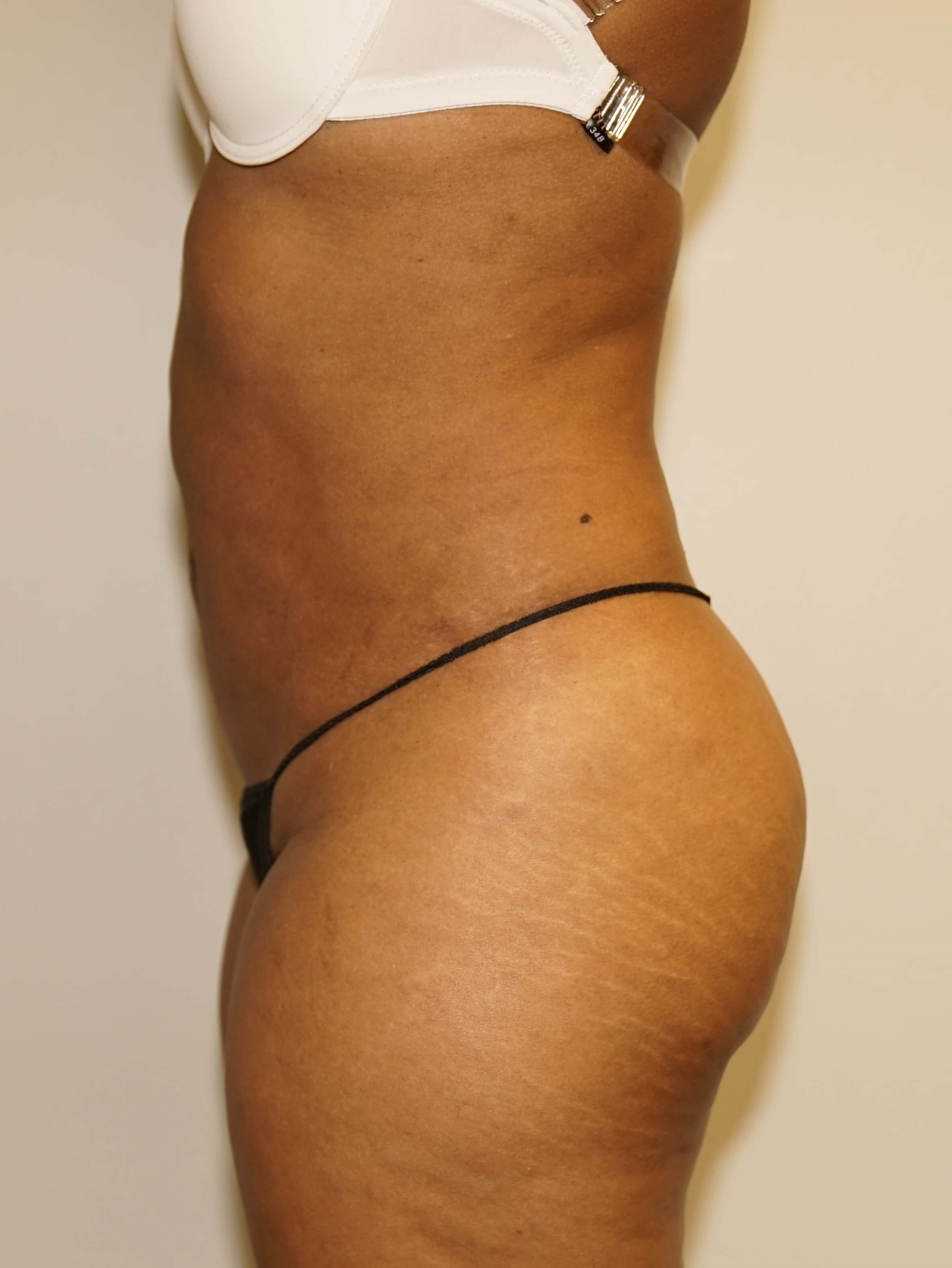 Westlake Woman Has Liposuction After
