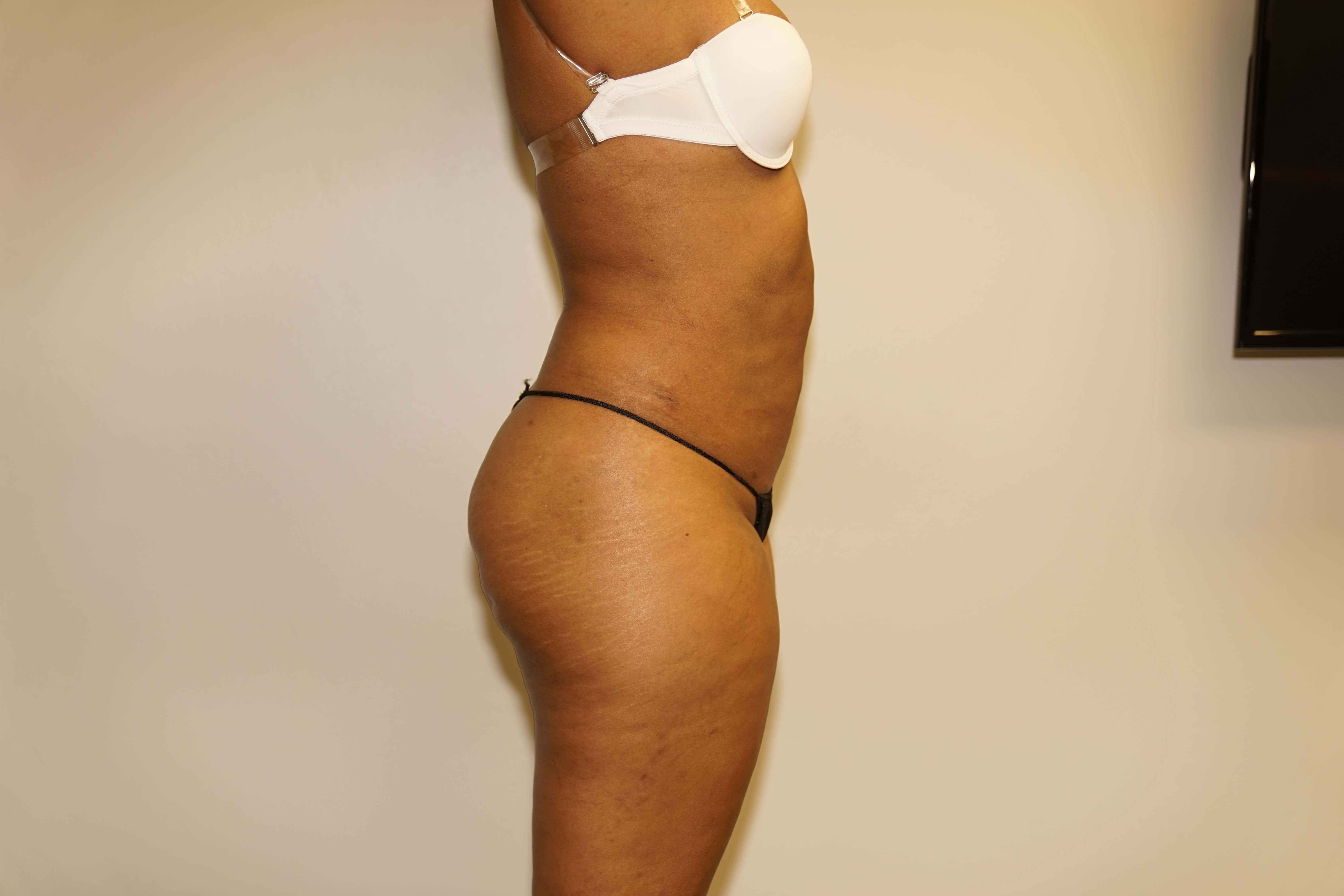 Westlake Woman Has Liposuction After