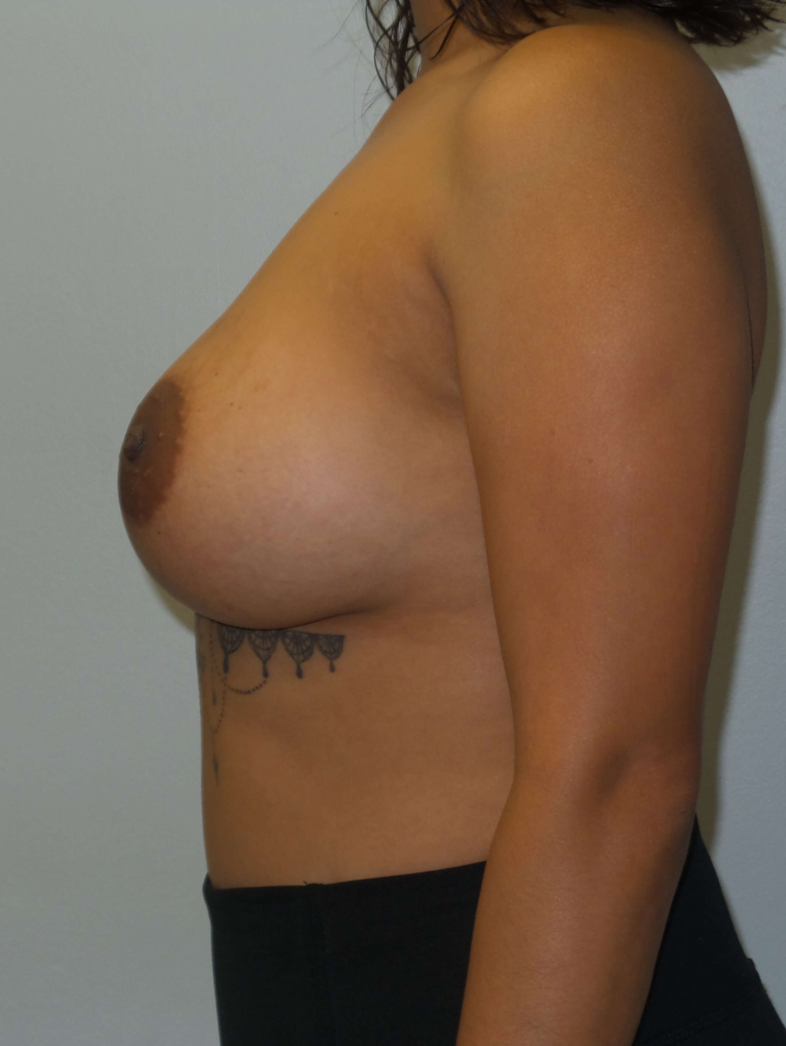 Woman has Breast Revision Before