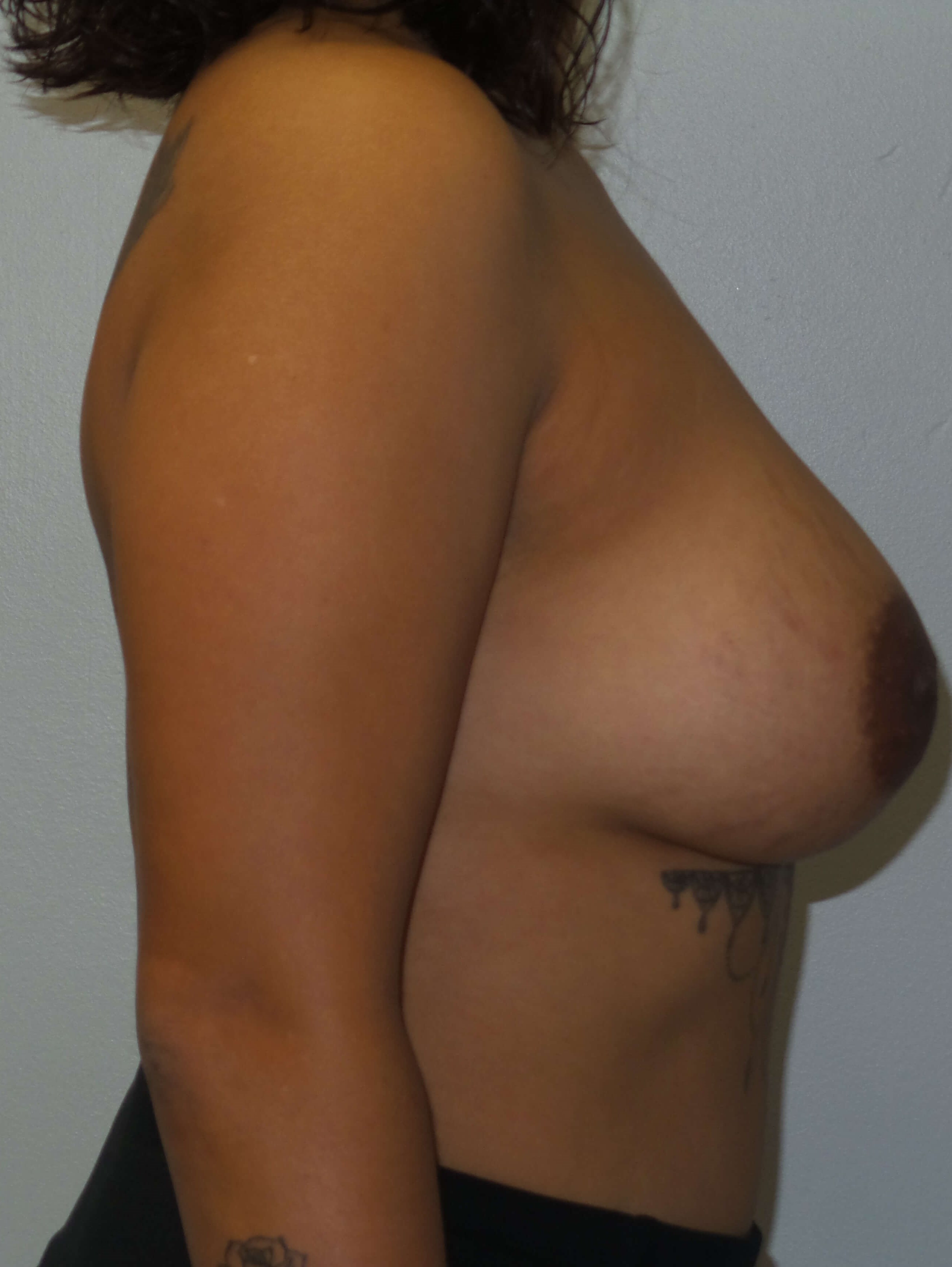 Woman has Breast Revision Before