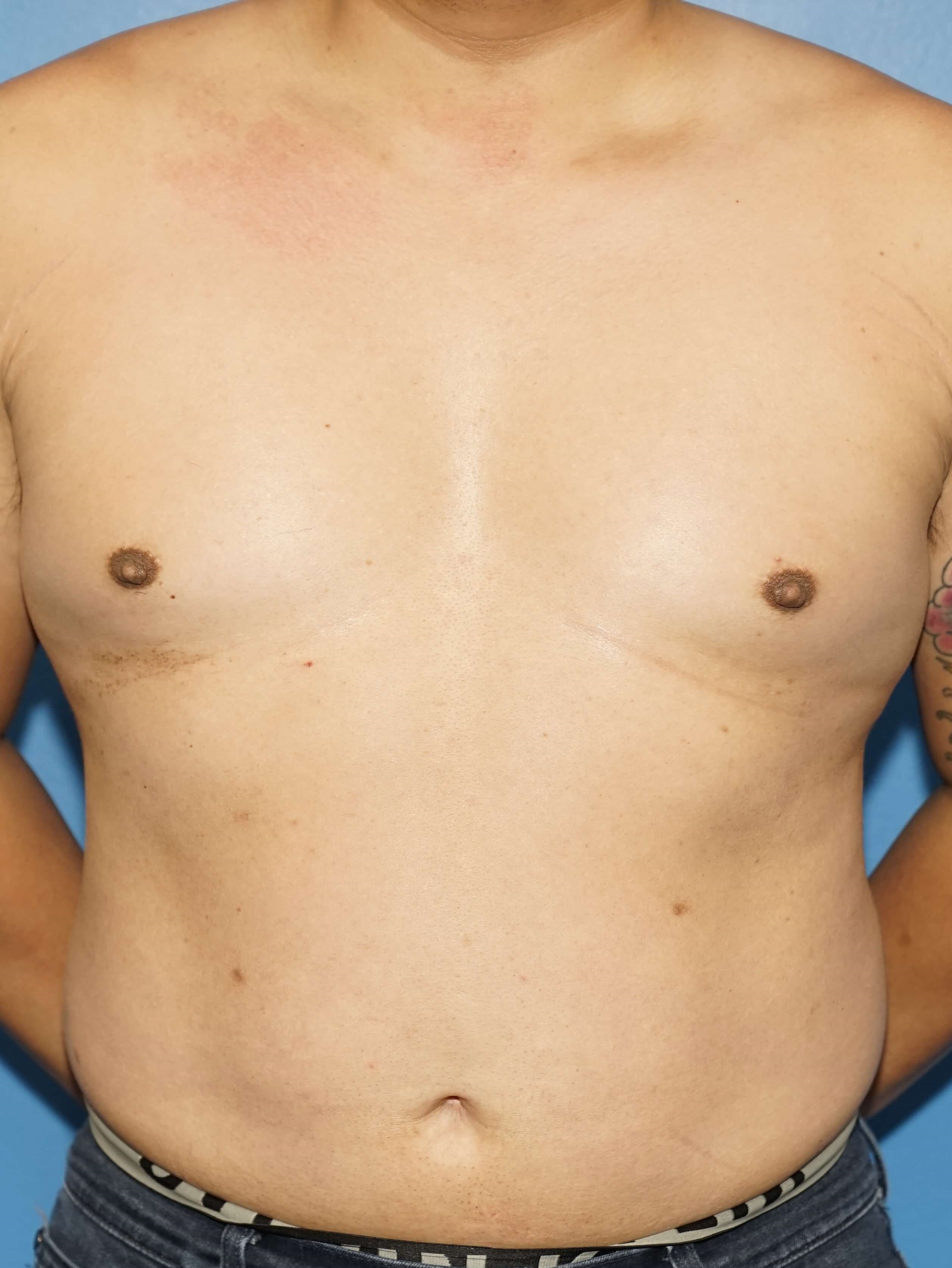 Man has Liposuction Abdomen Before