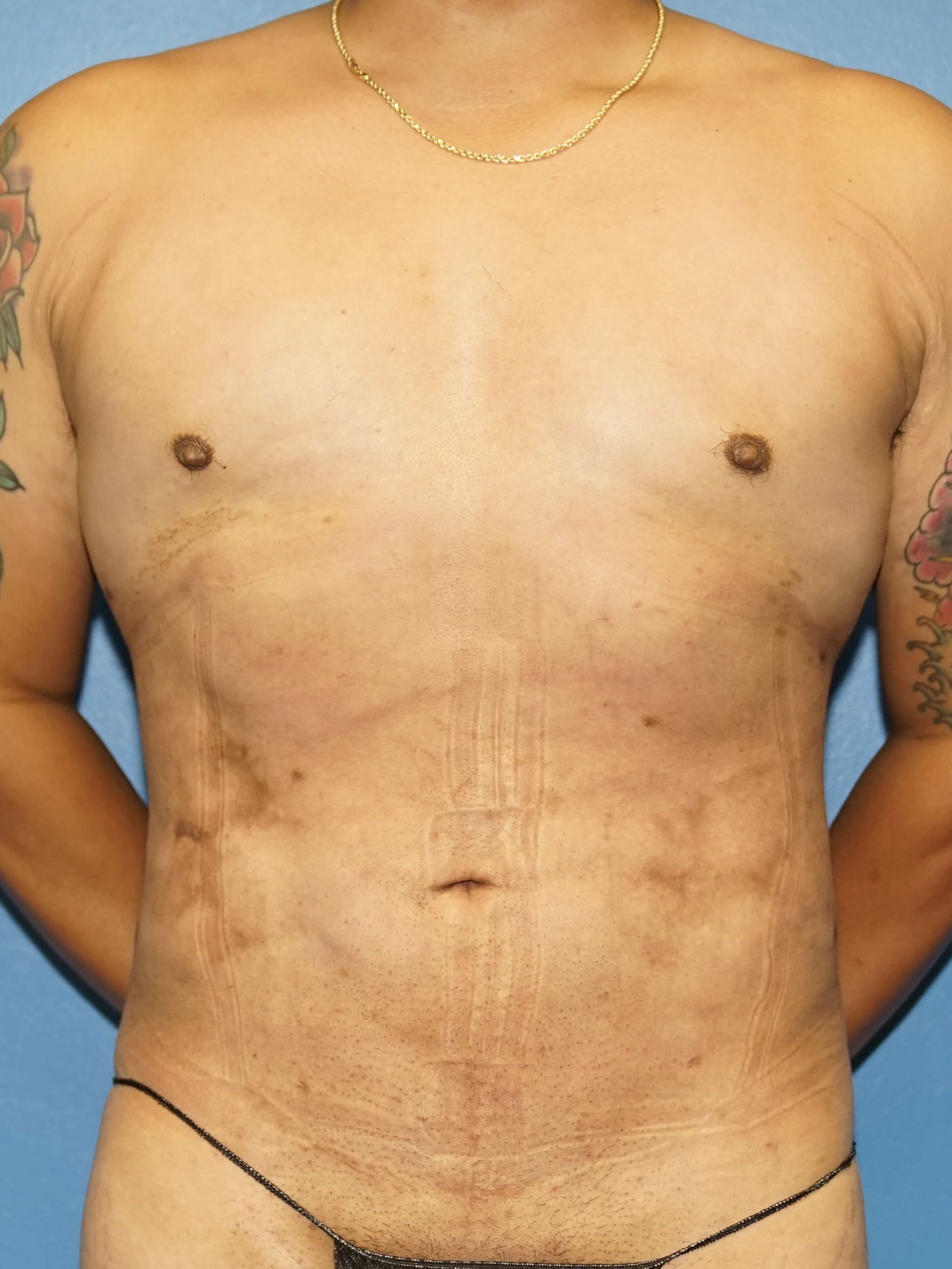 Man has Liposuction Abdomen After