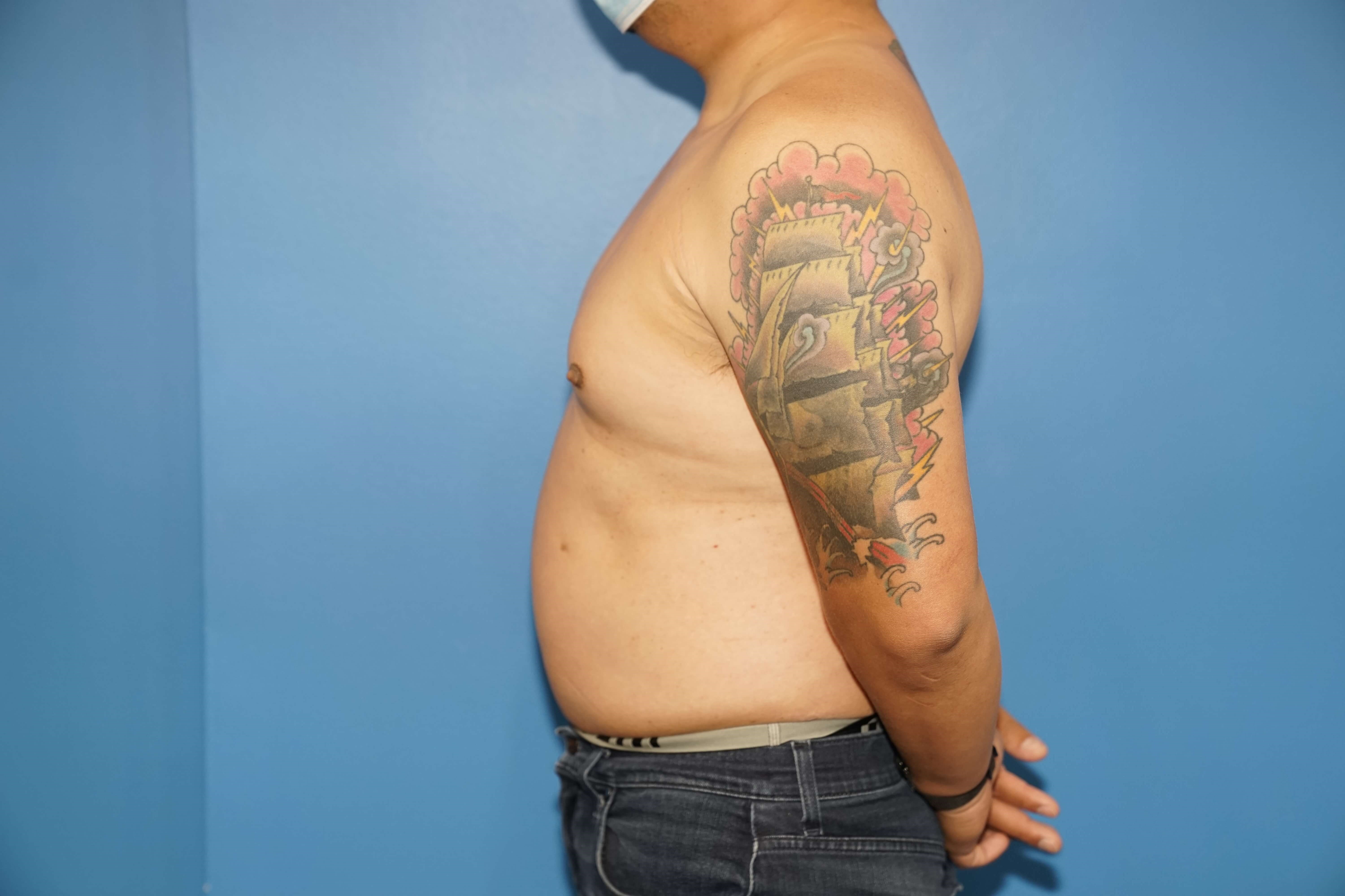 Man has Liposuction Chest Before