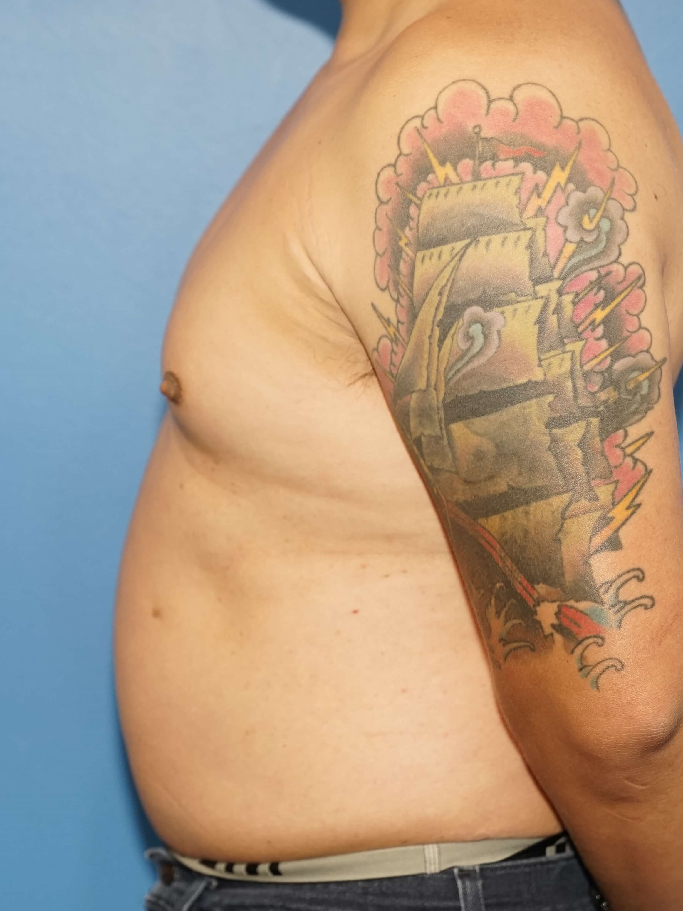 Man has Liposuction Chest Before