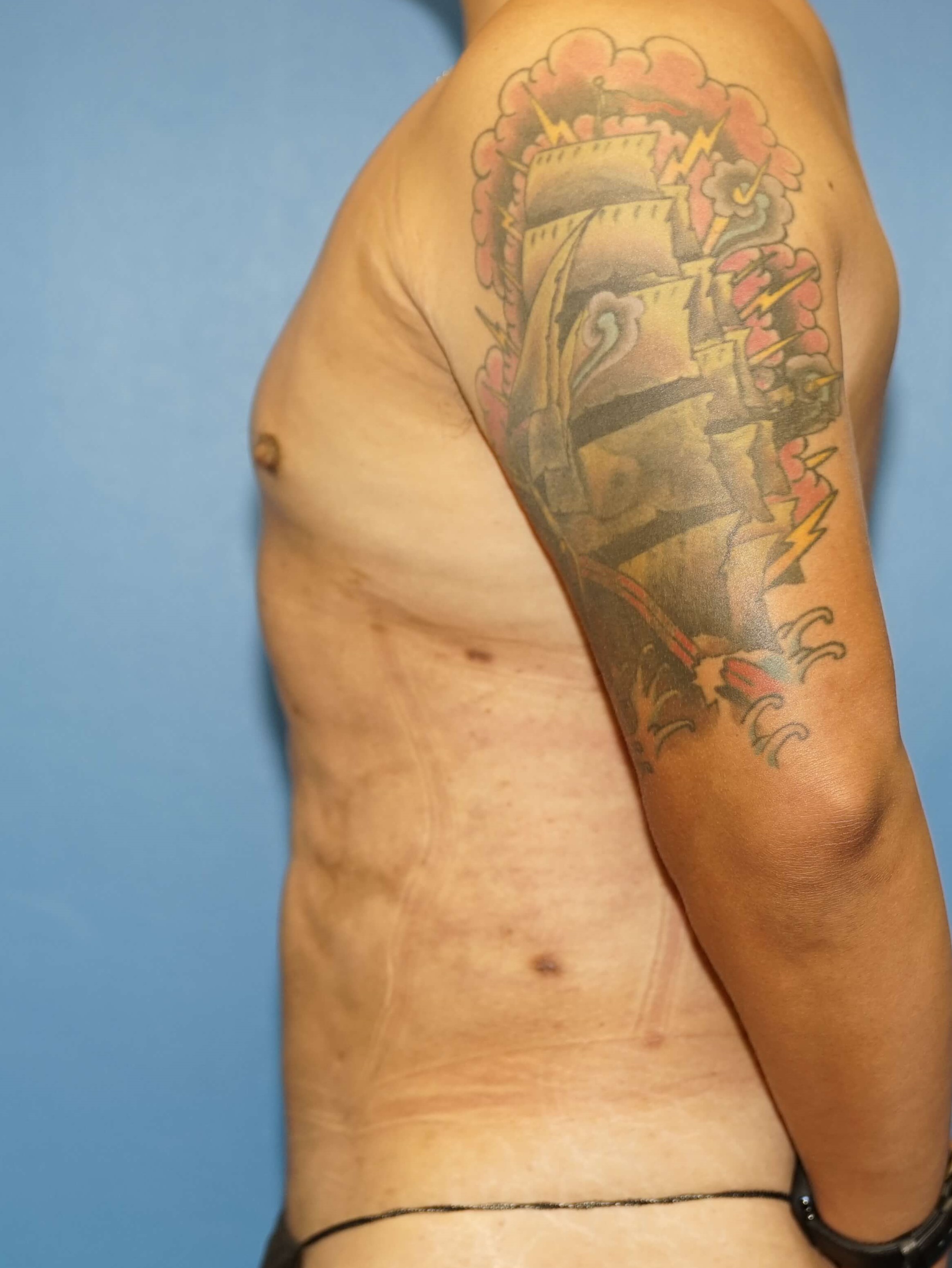 Man has Liposuction Chest After