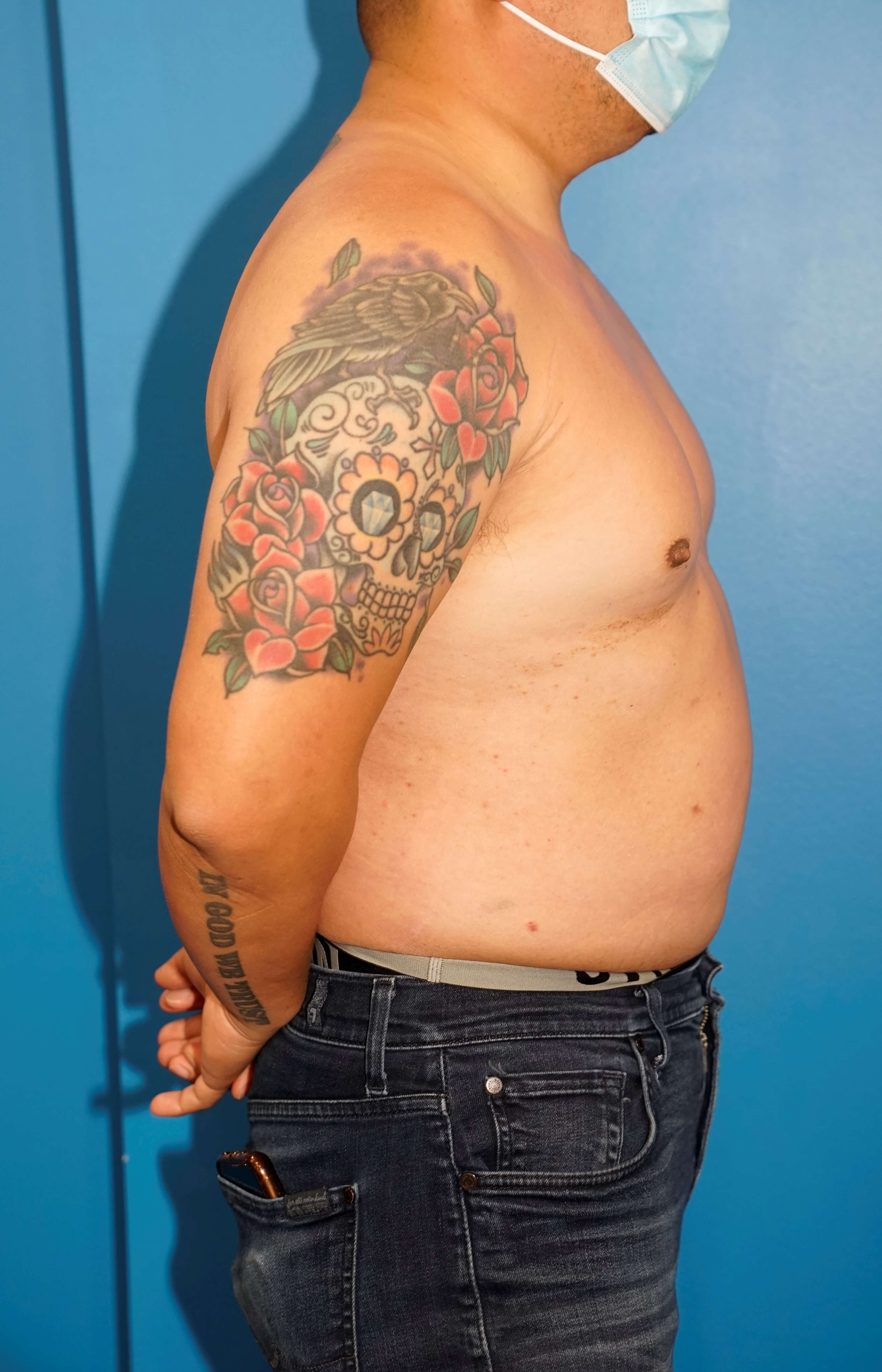Man has Liposuction Chest Before