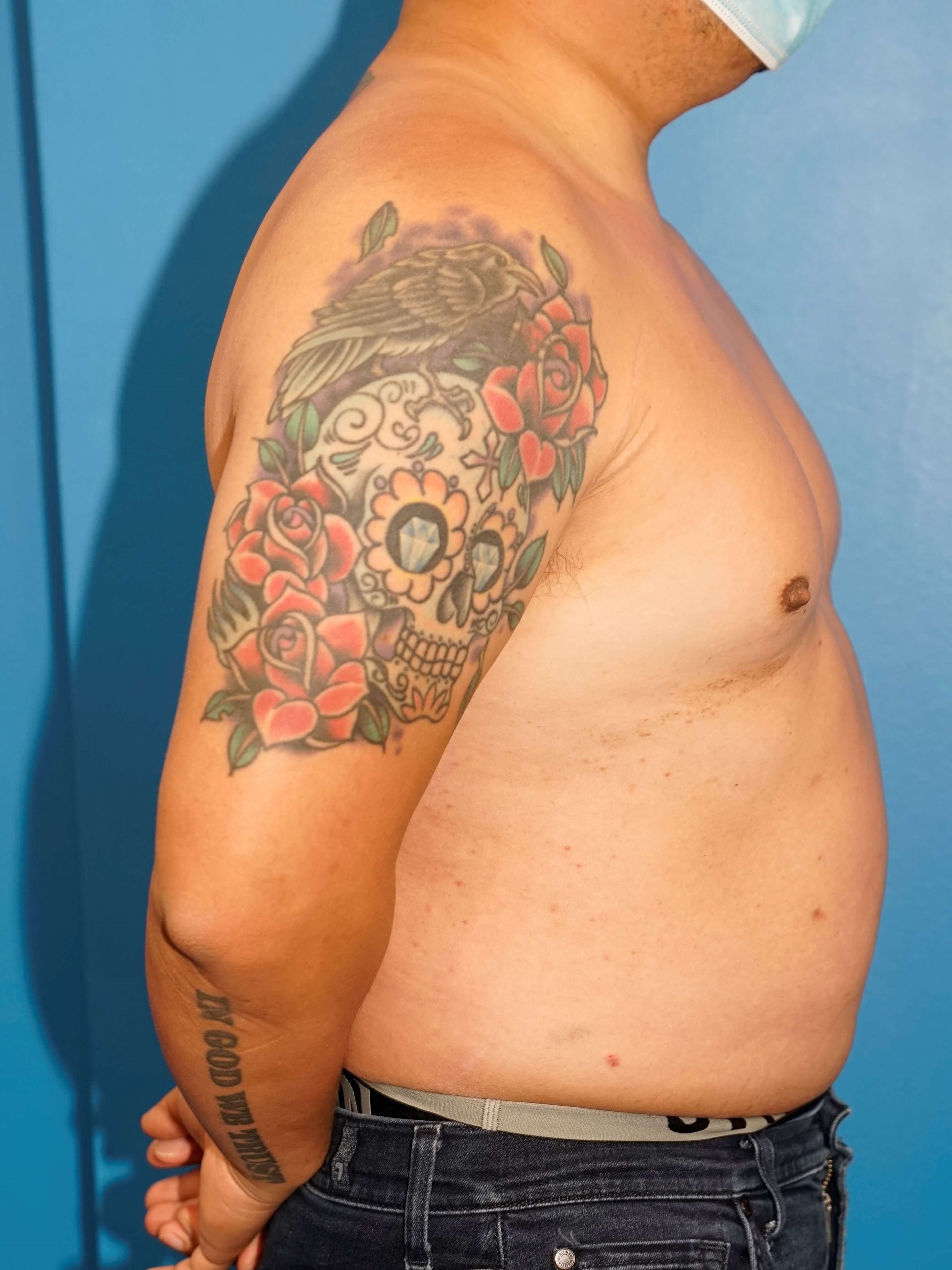 Man has Liposuction Chest Before