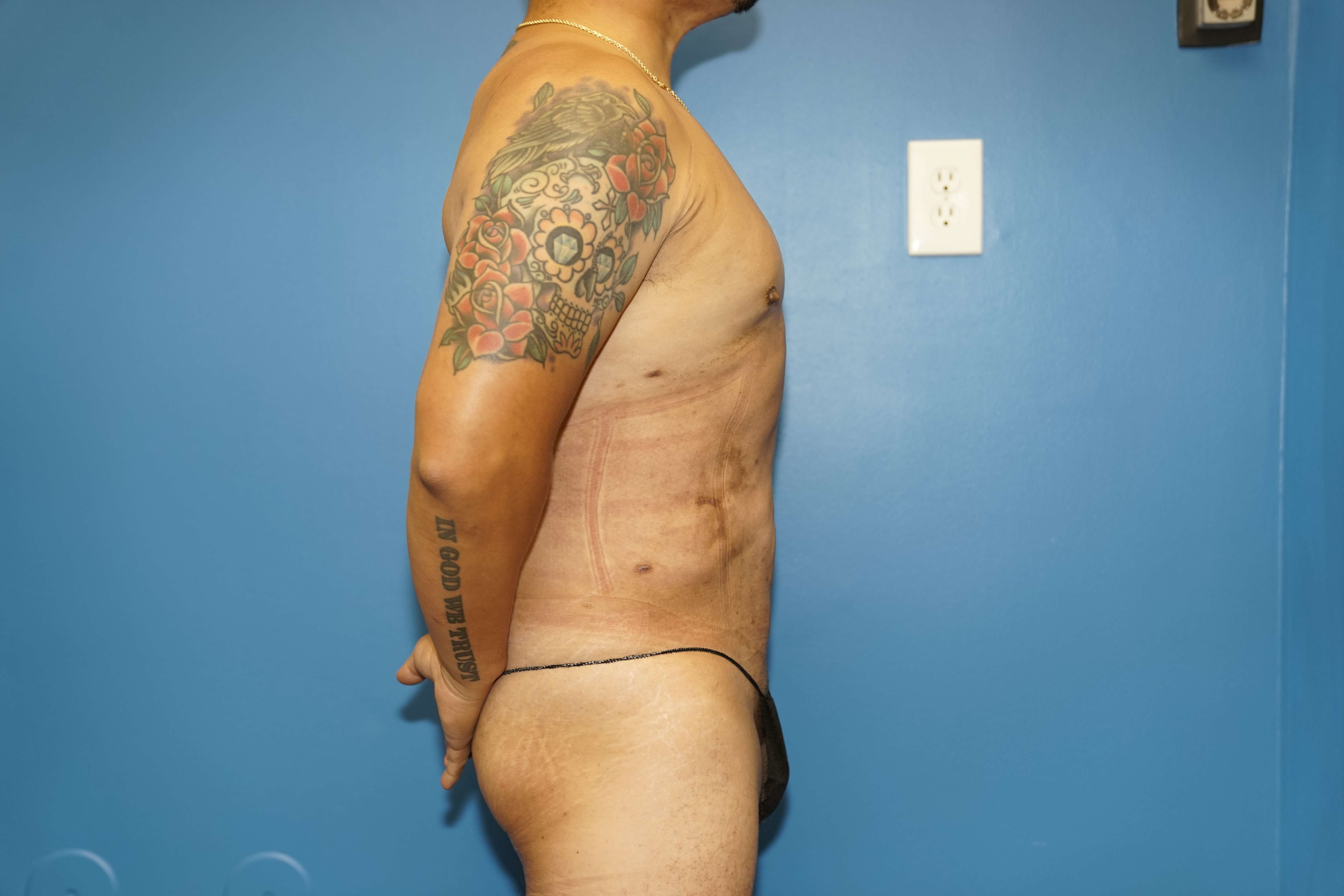Man has Liposuction Chest After