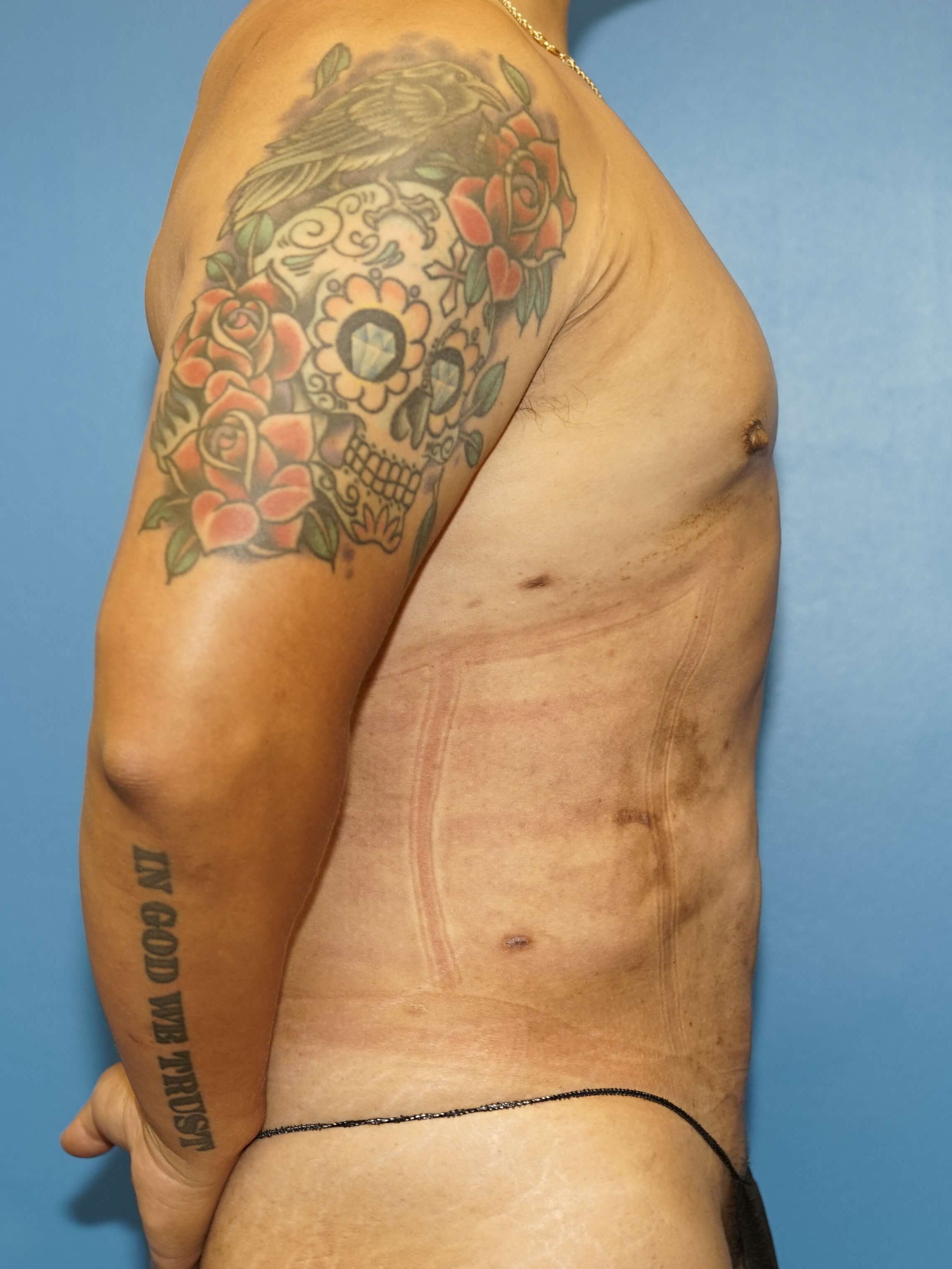 Man has Liposuction Chest After