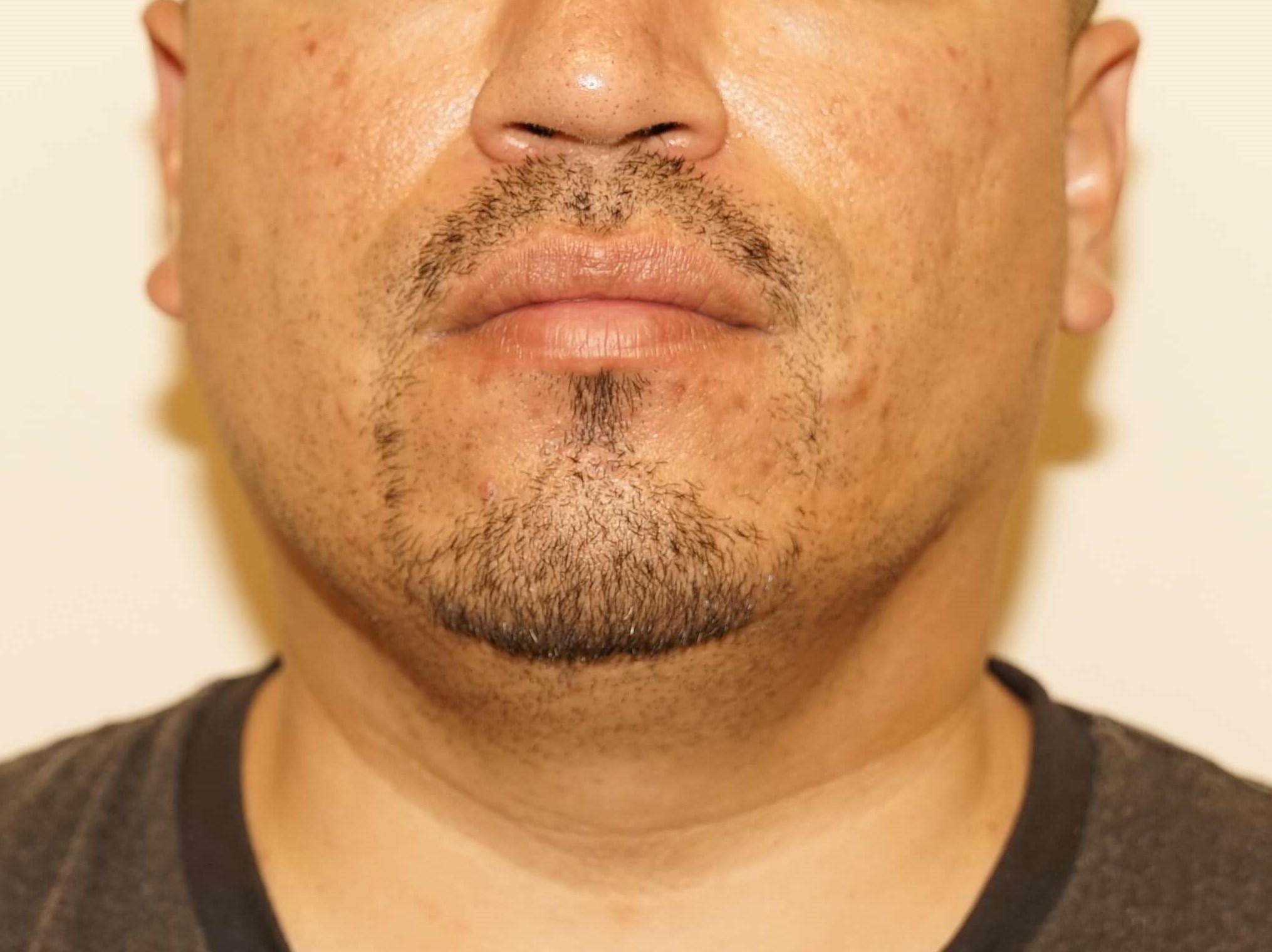 Man has Liposuction Neck Before
