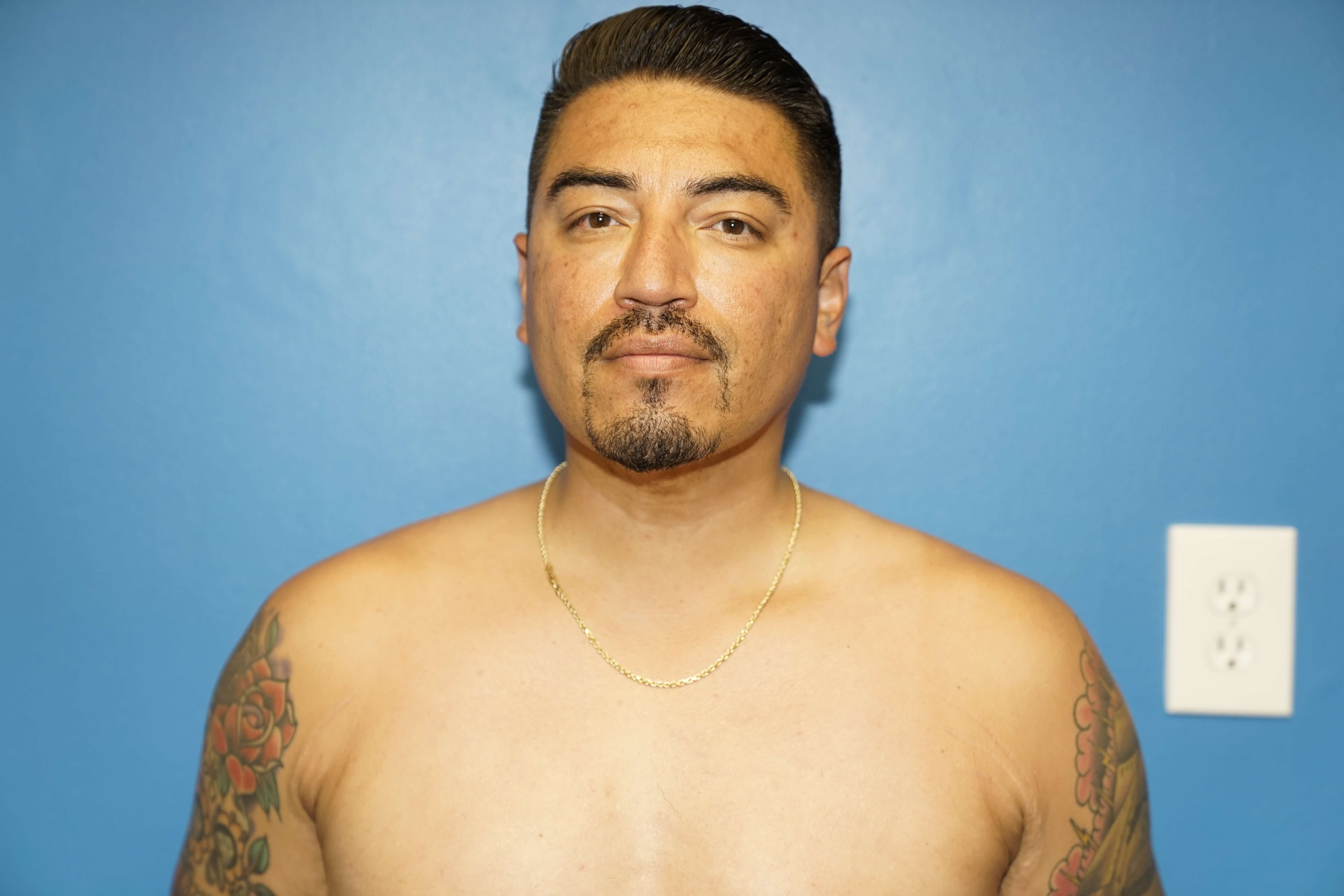 Man has Liposuction Neck After