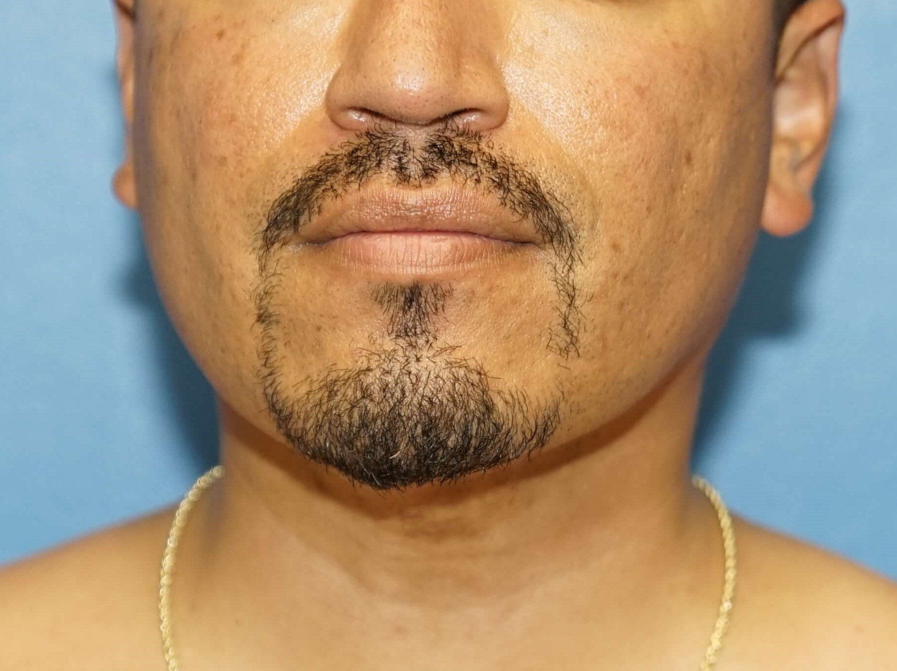Man has Liposuction Neck After