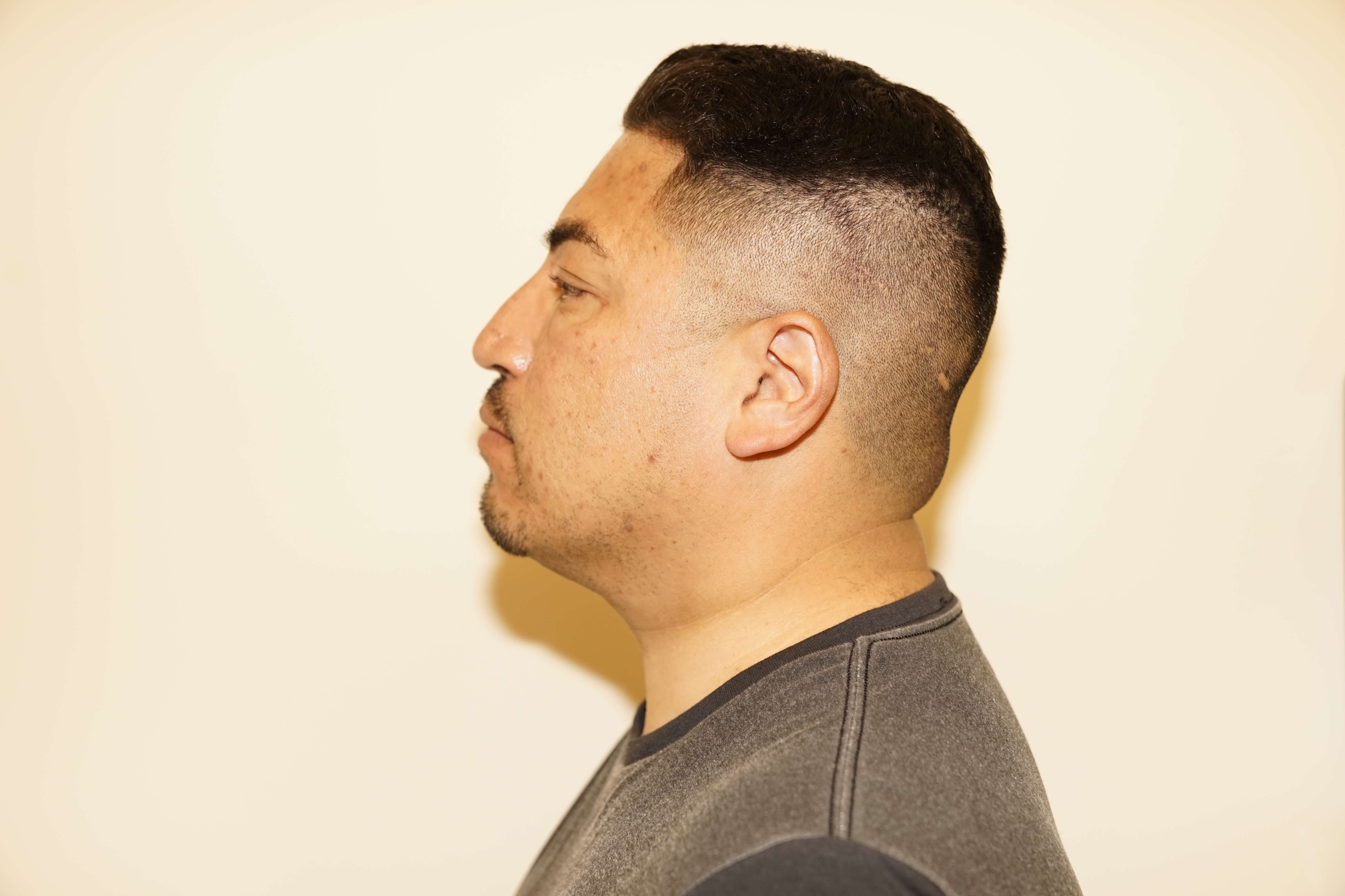 Man has Liposuction Neck Before