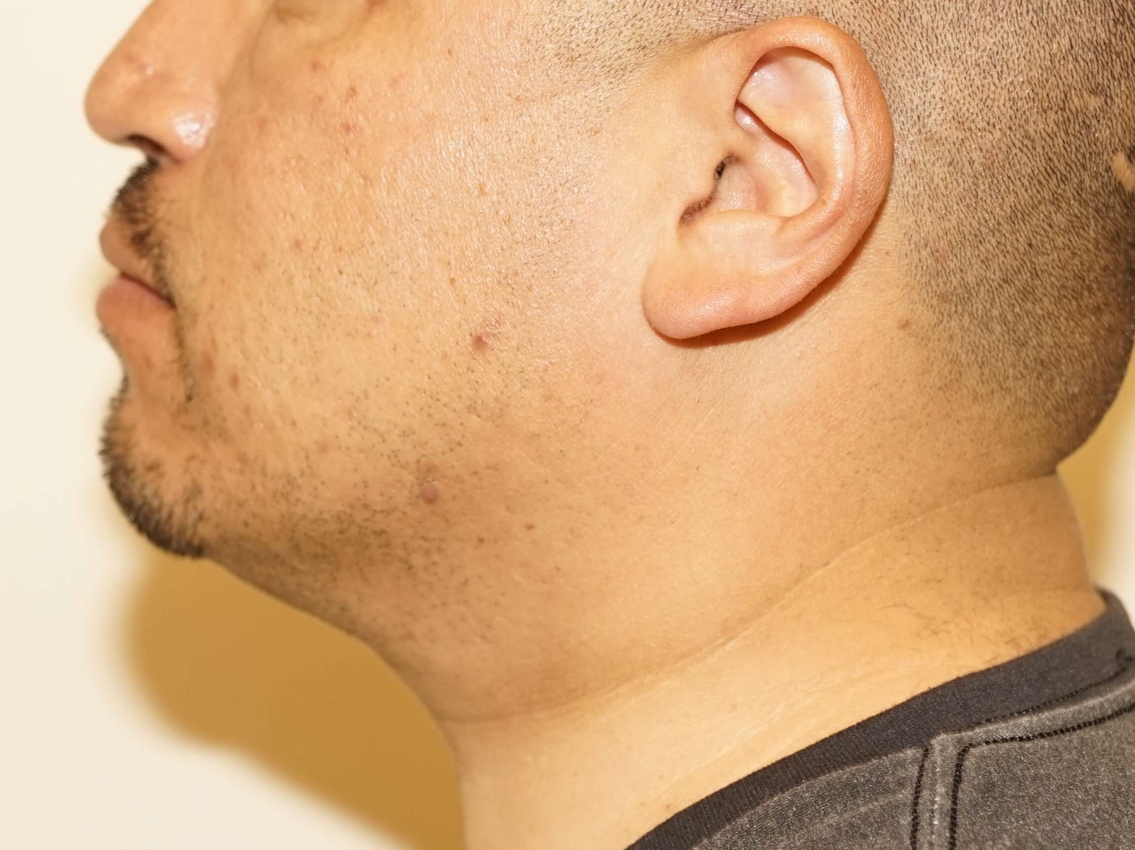Man has Liposuction Neck Before