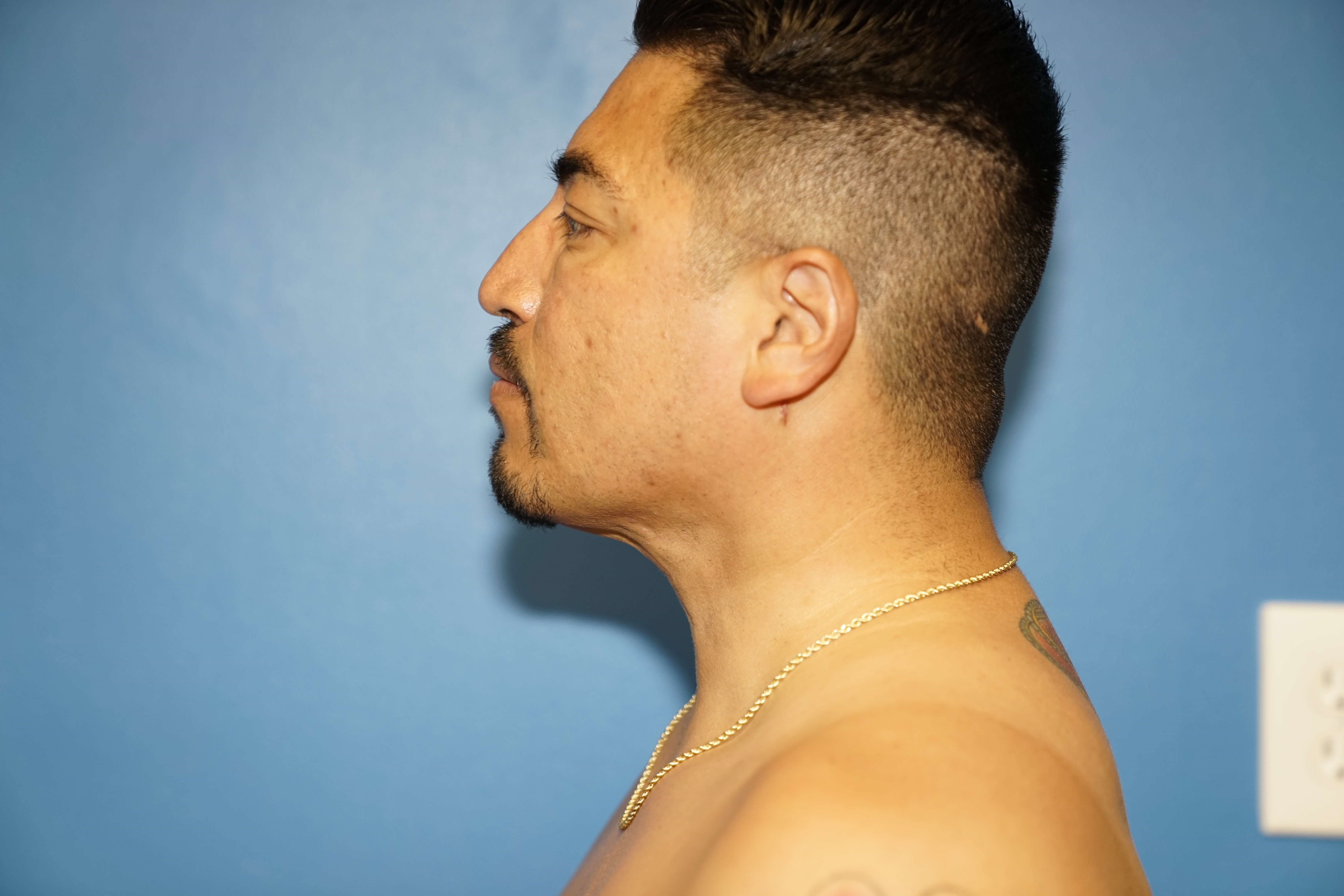 Man has Liposuction Neck After