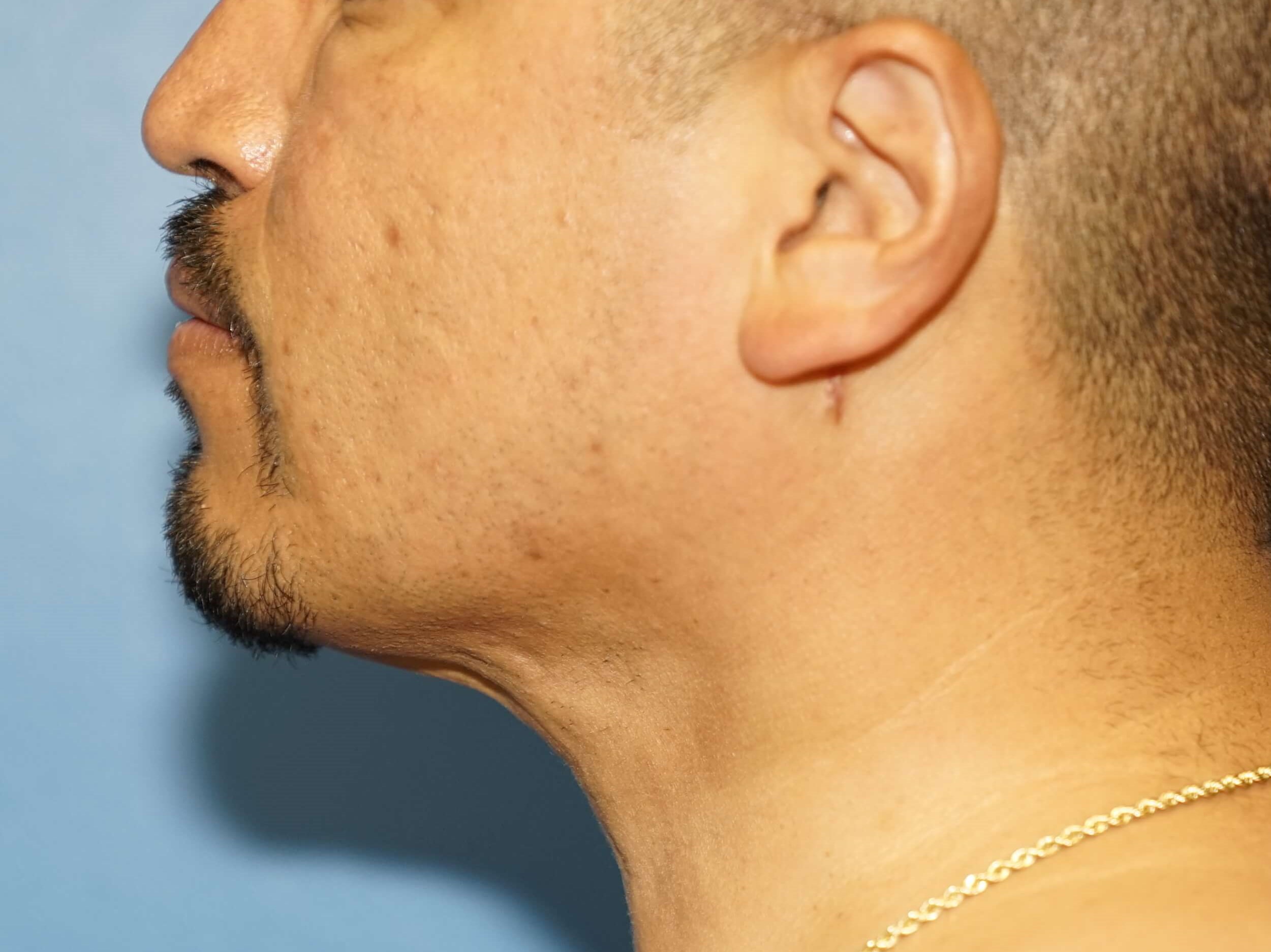 Man has Liposuction Neck After