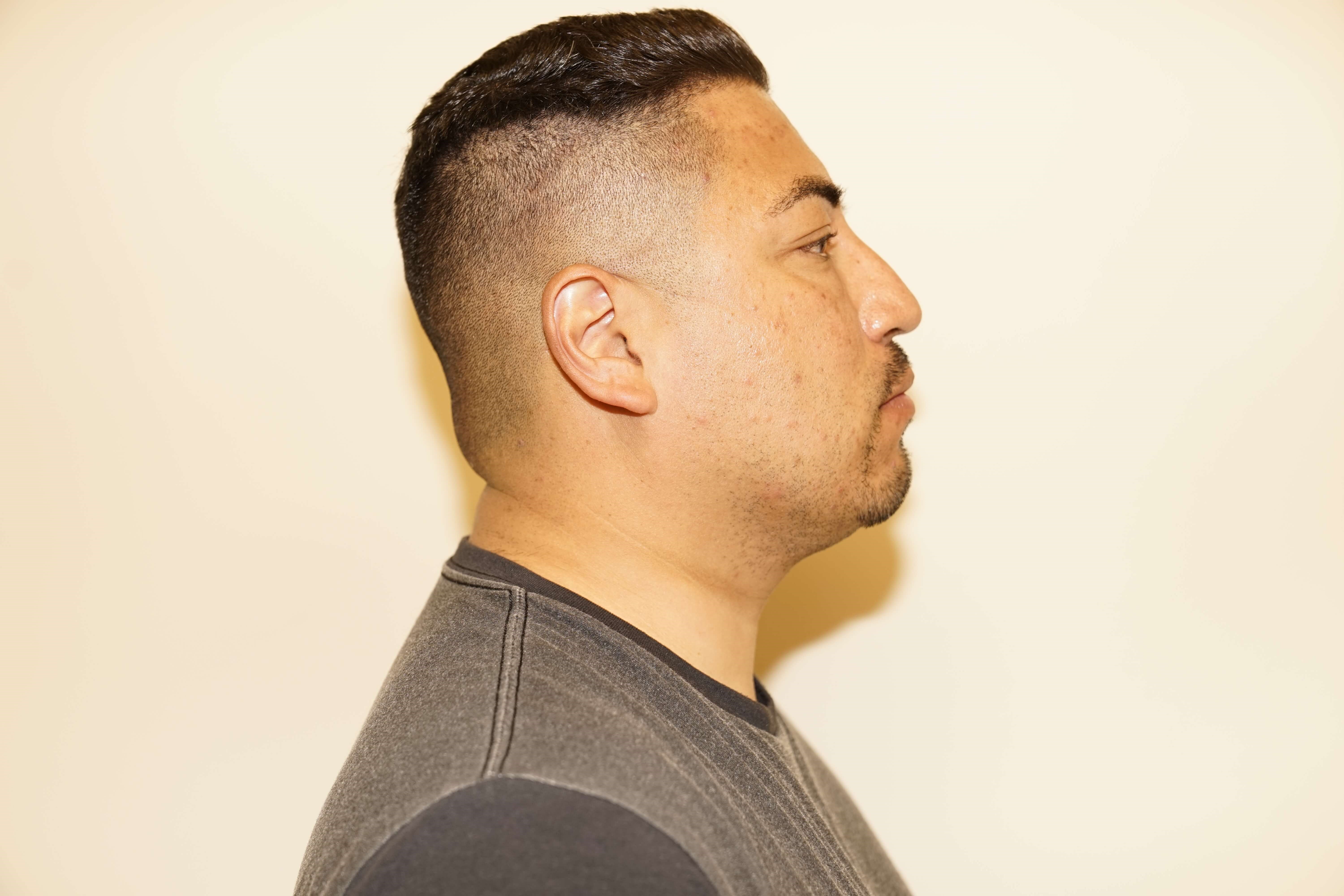 Man has Liposuction Neck Before