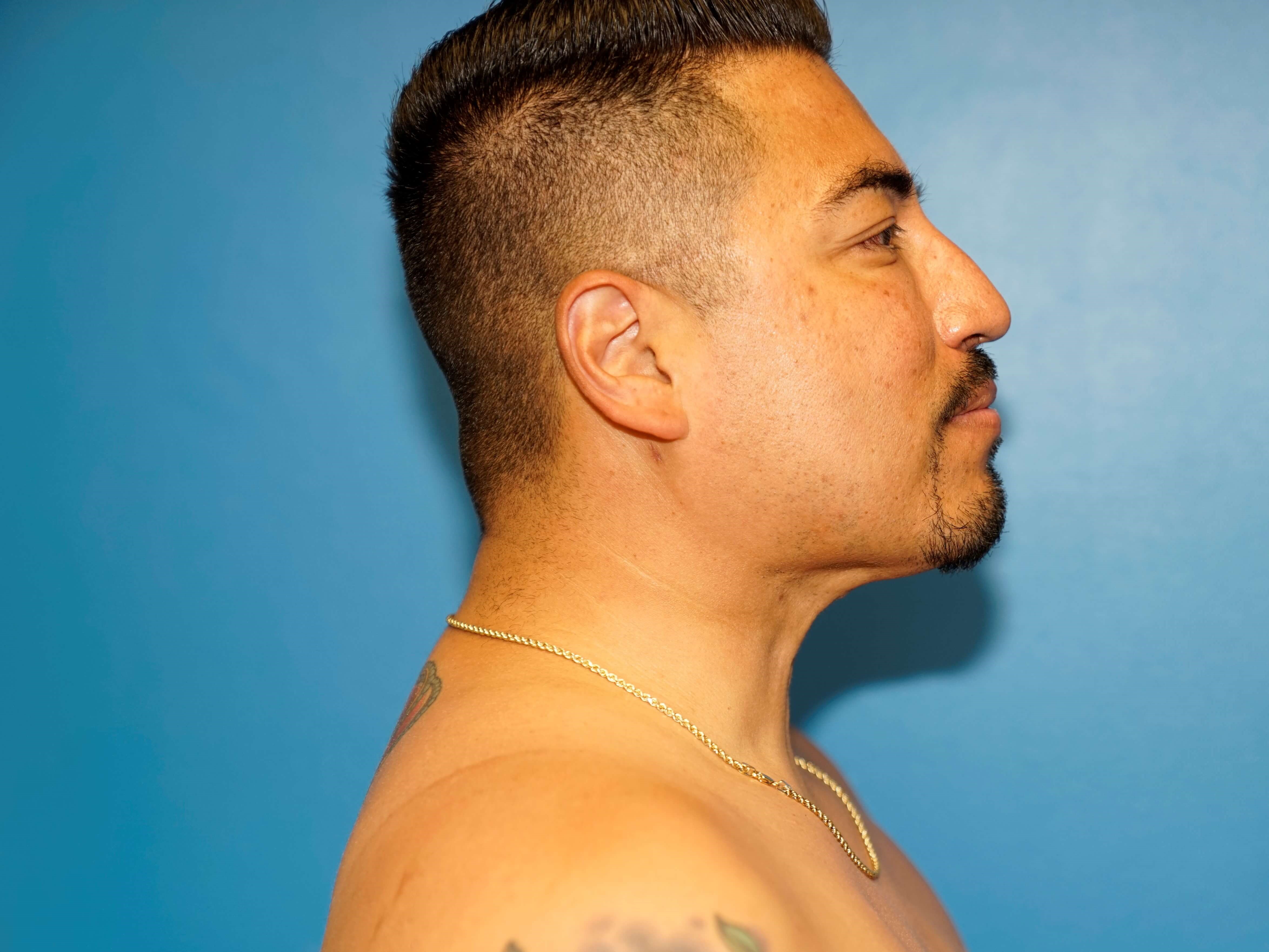 Man has Liposuction Neck After