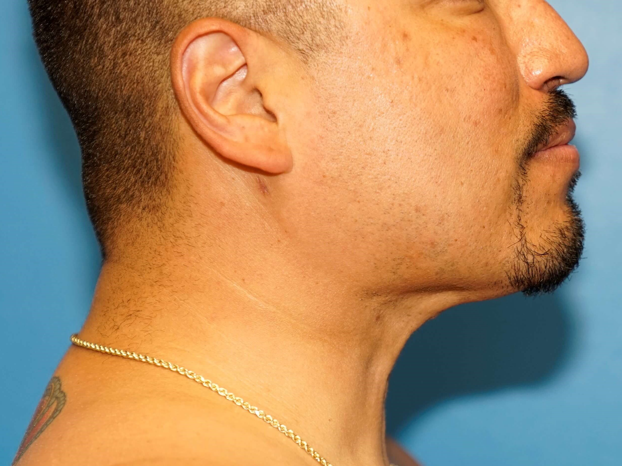 Man has Liposuction Neck After