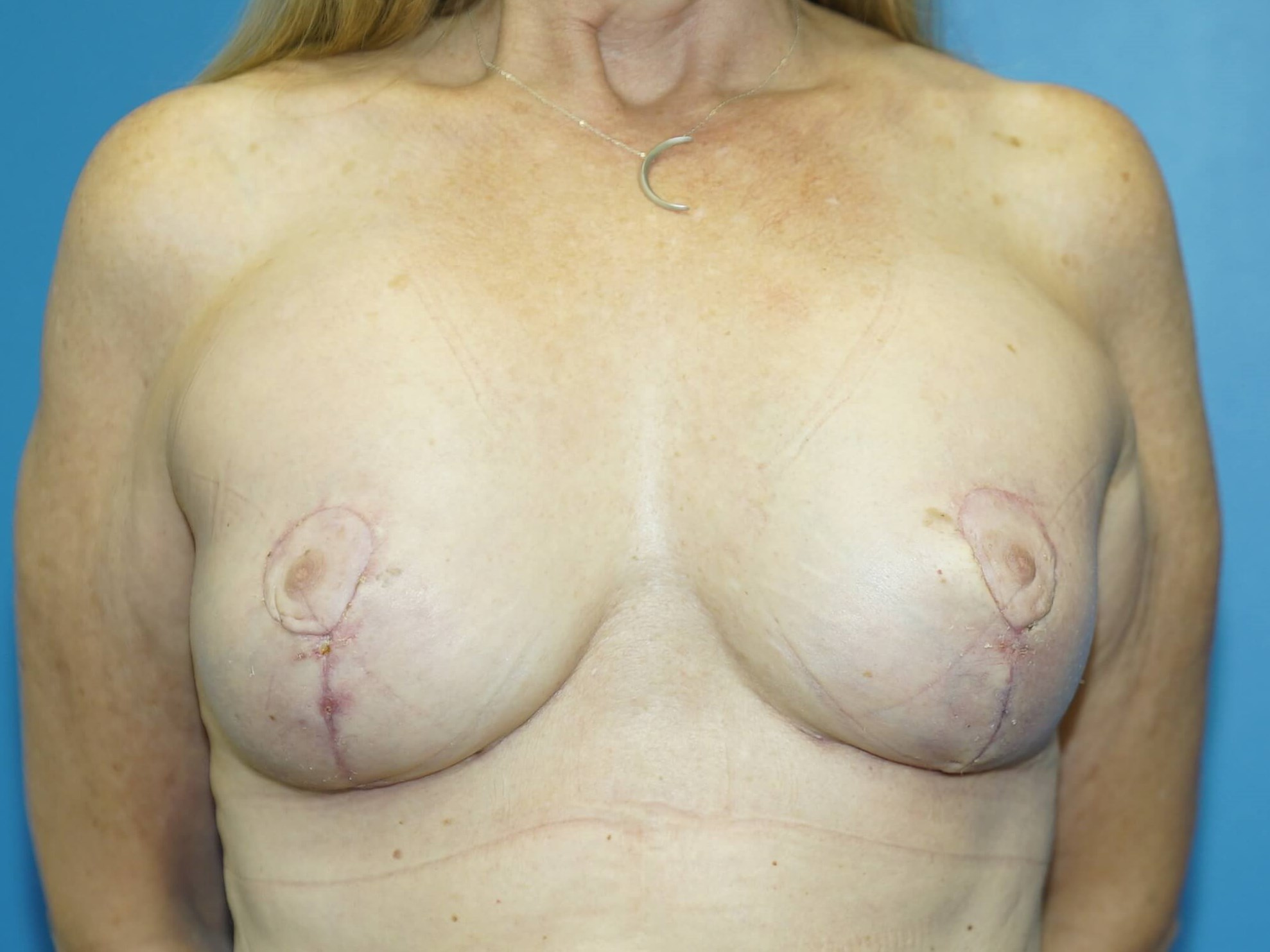 Woman has Breast Lift + Aug After