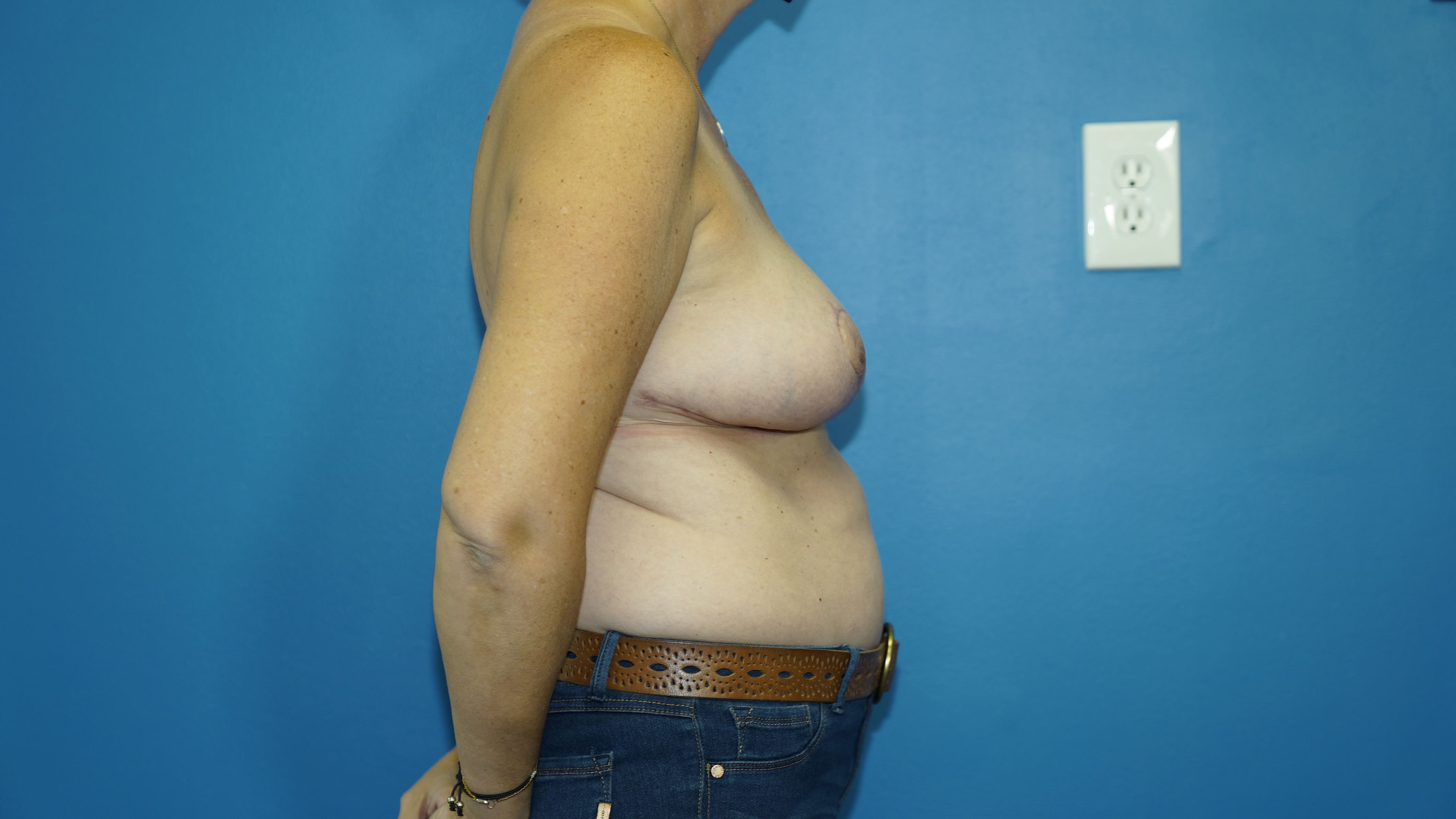 Woman has Breast Lift After