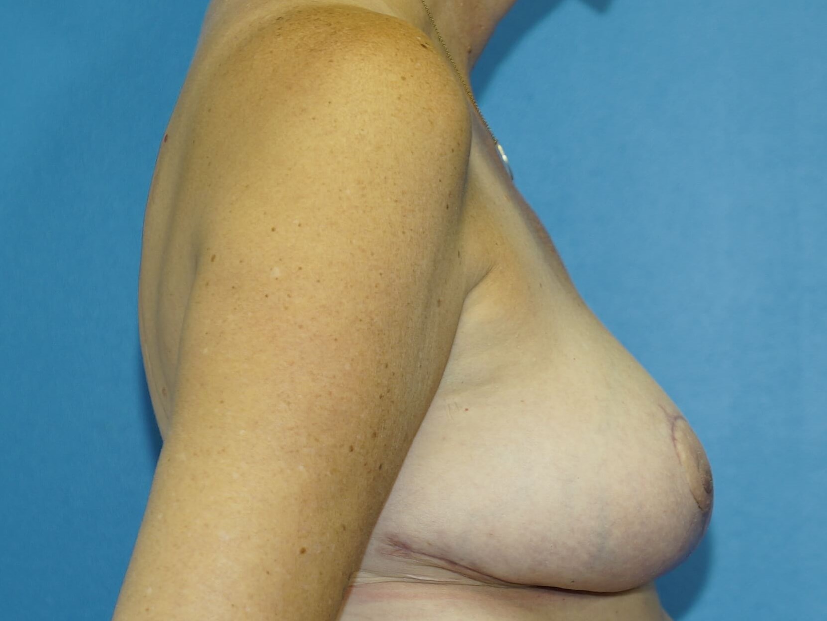 Woman has Breast Lift After