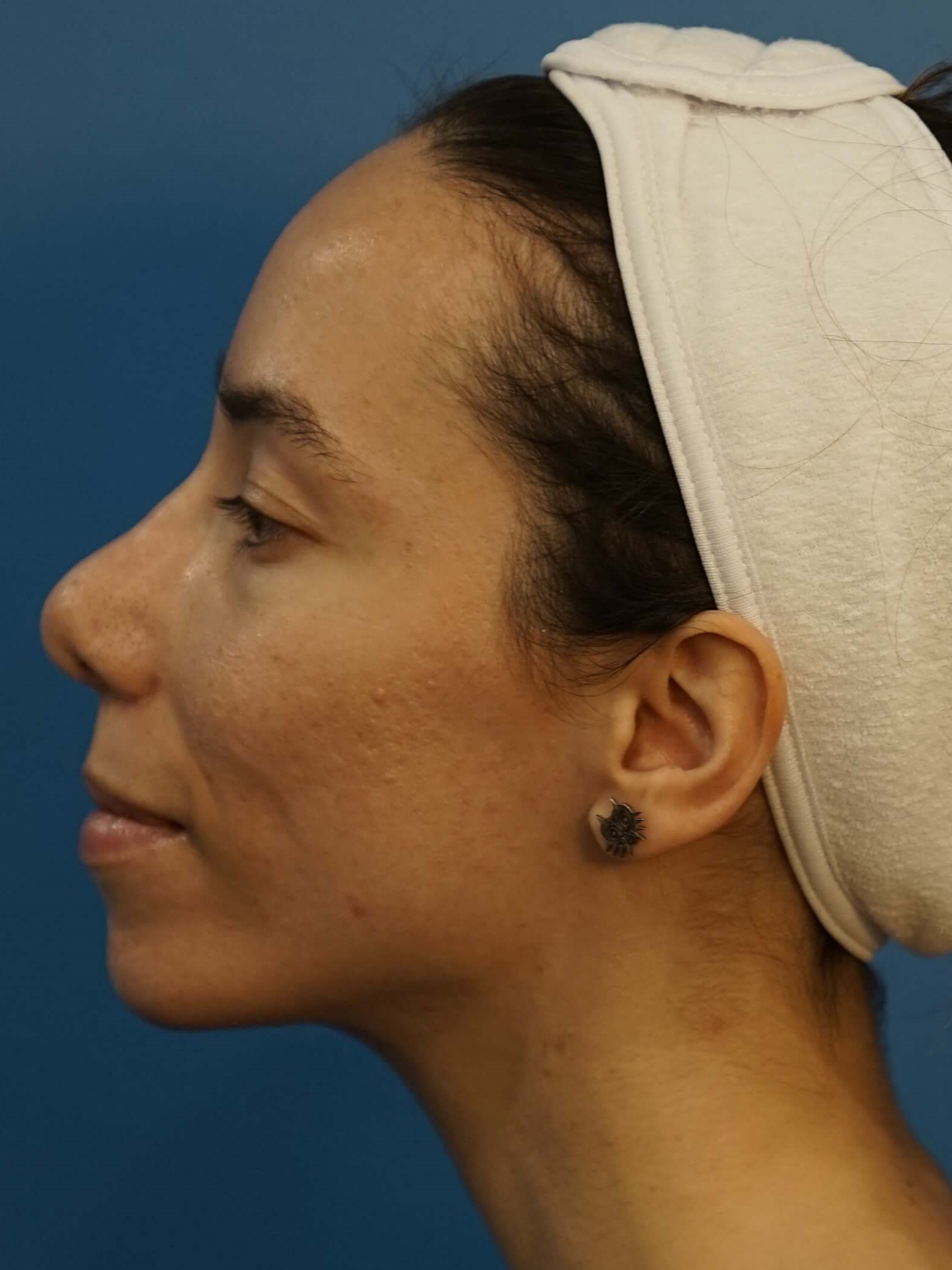 Los Angeles Rhinoplasty After