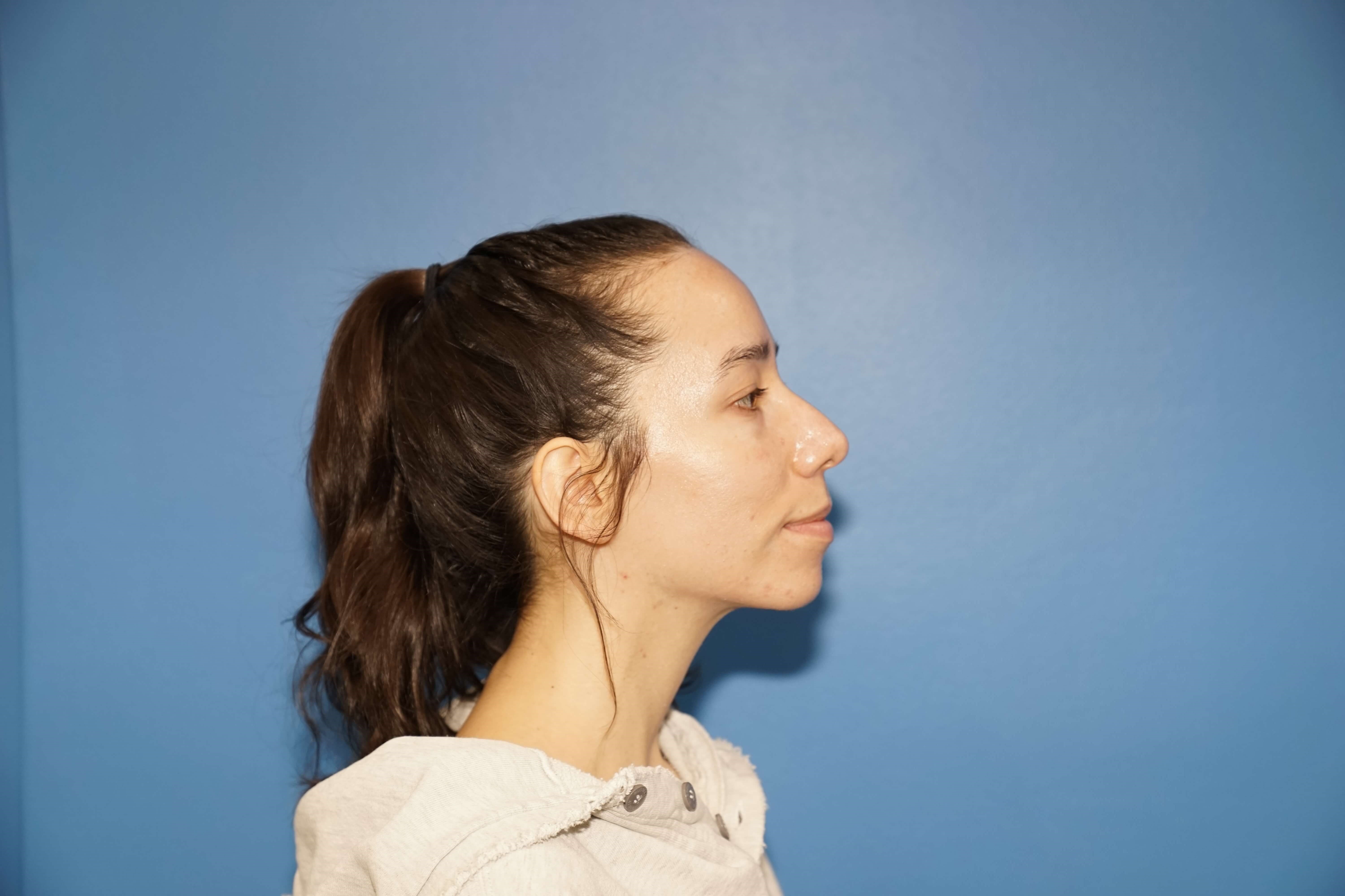 Los Angeles Rhinoplasty Before