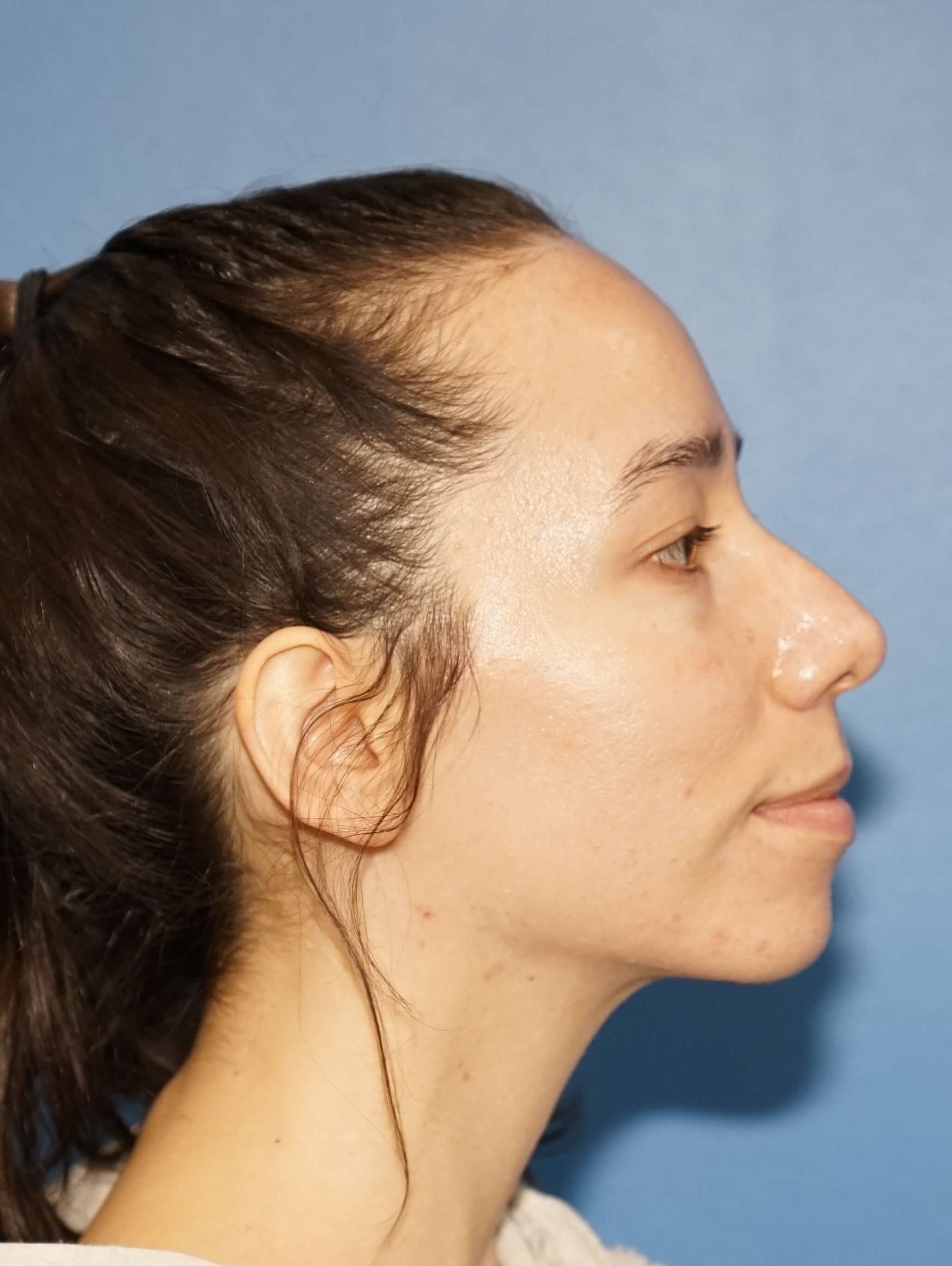 Los Angeles Rhinoplasty Before