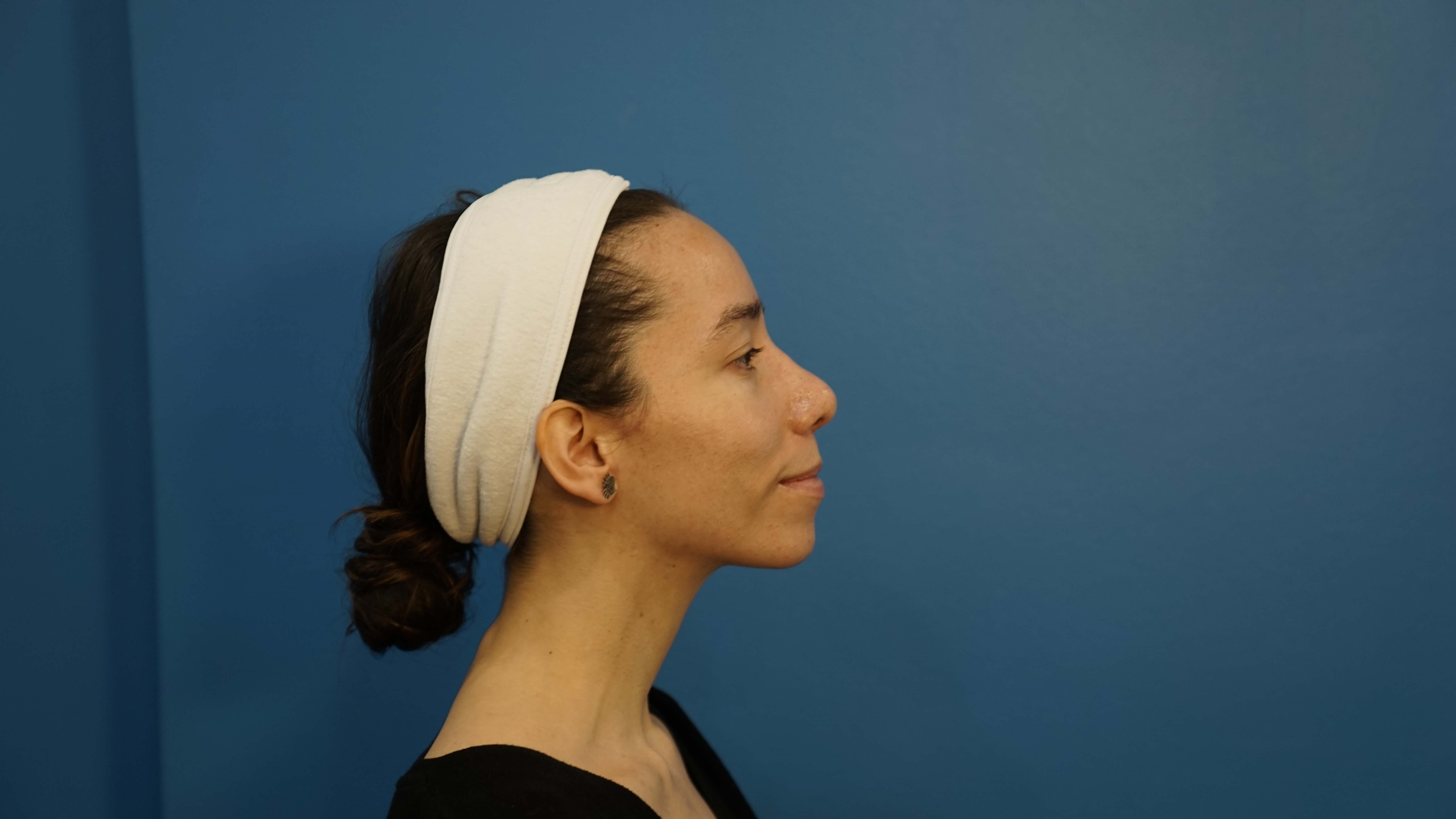 Los Angeles Rhinoplasty After