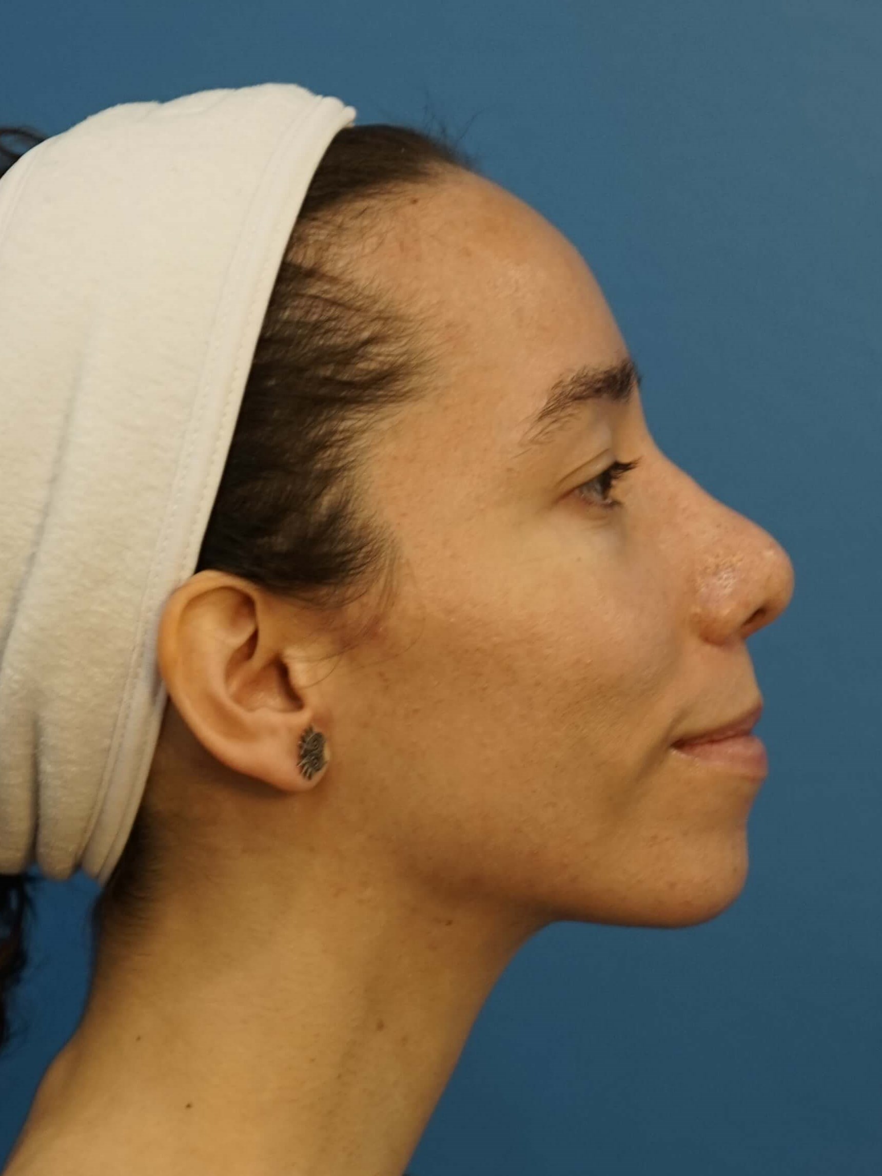 Los Angeles Rhinoplasty After