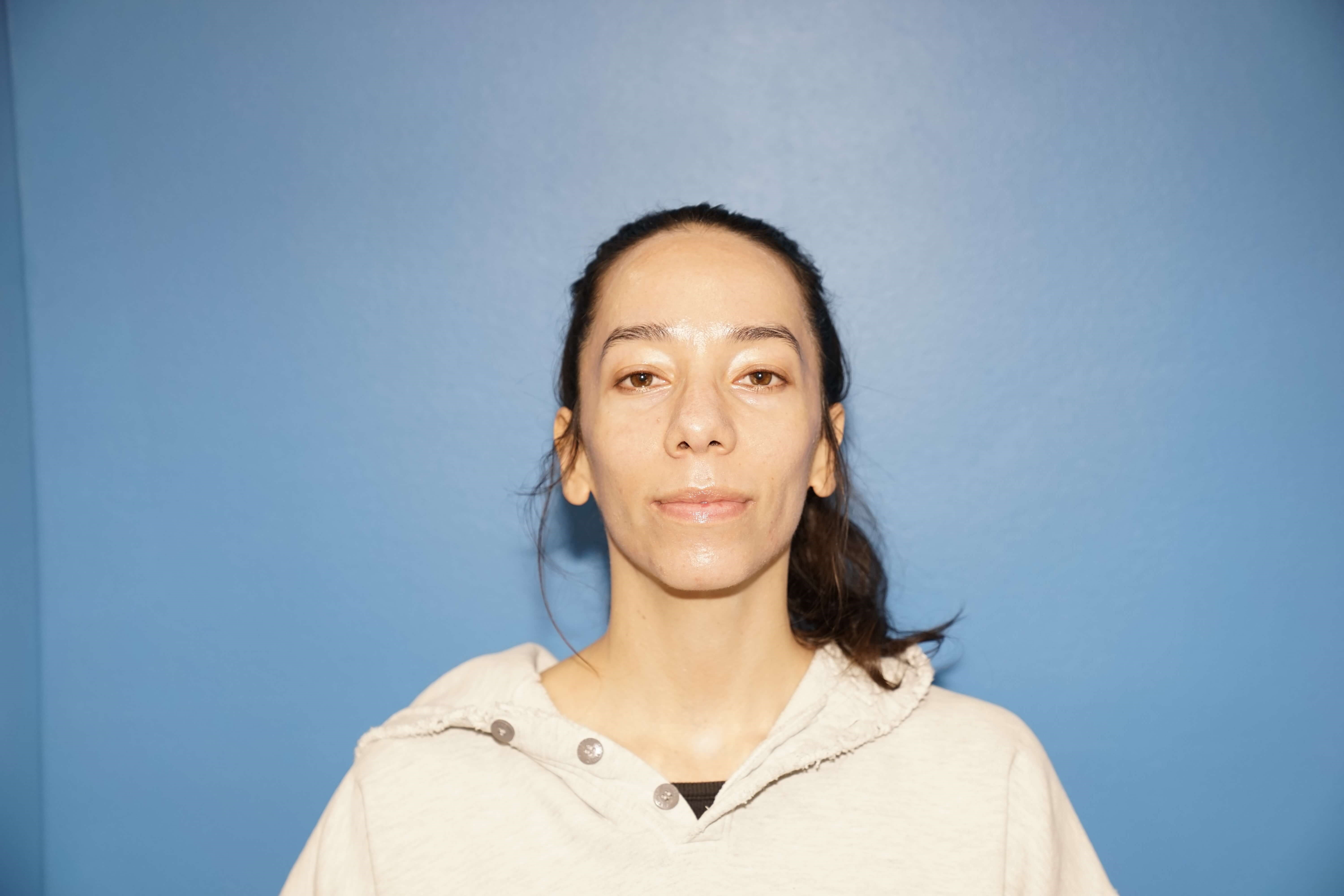 Los Angeles Rhinoplasty Before