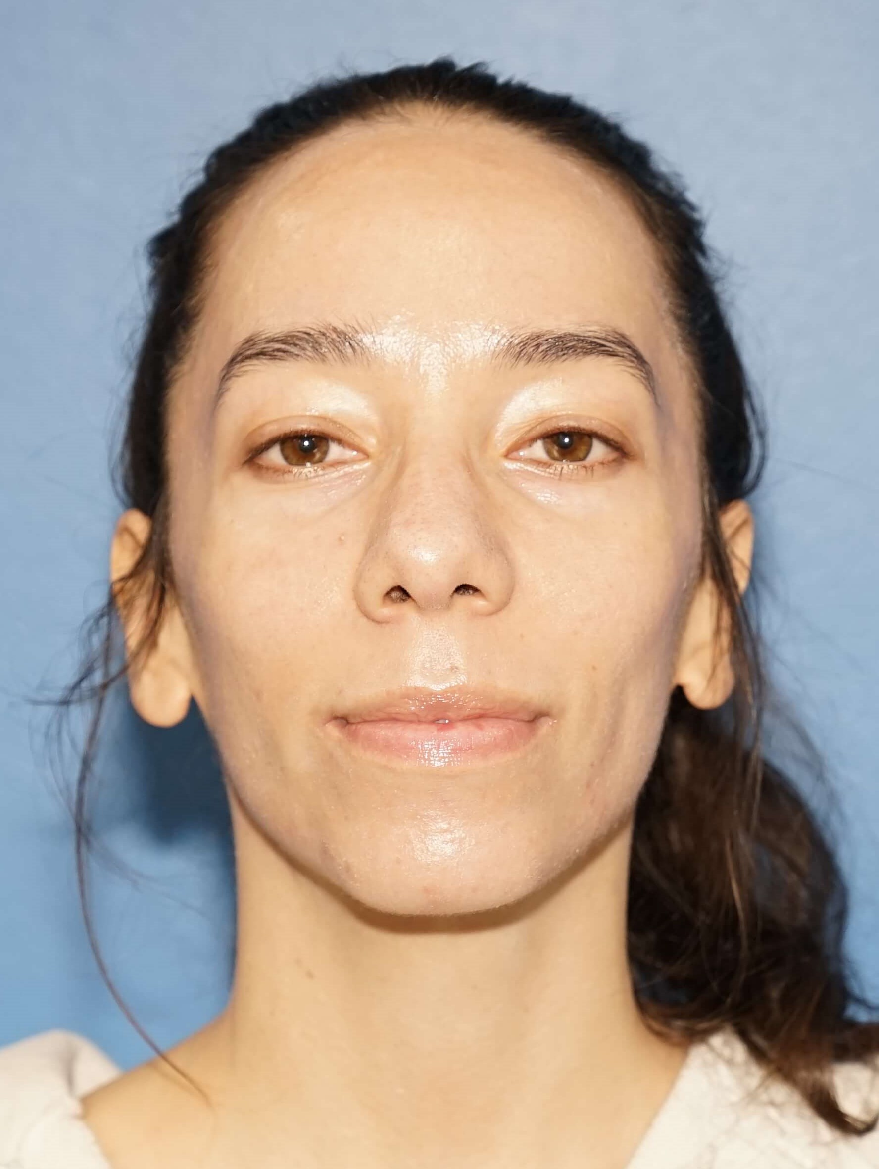 Los Angeles Rhinoplasty Before