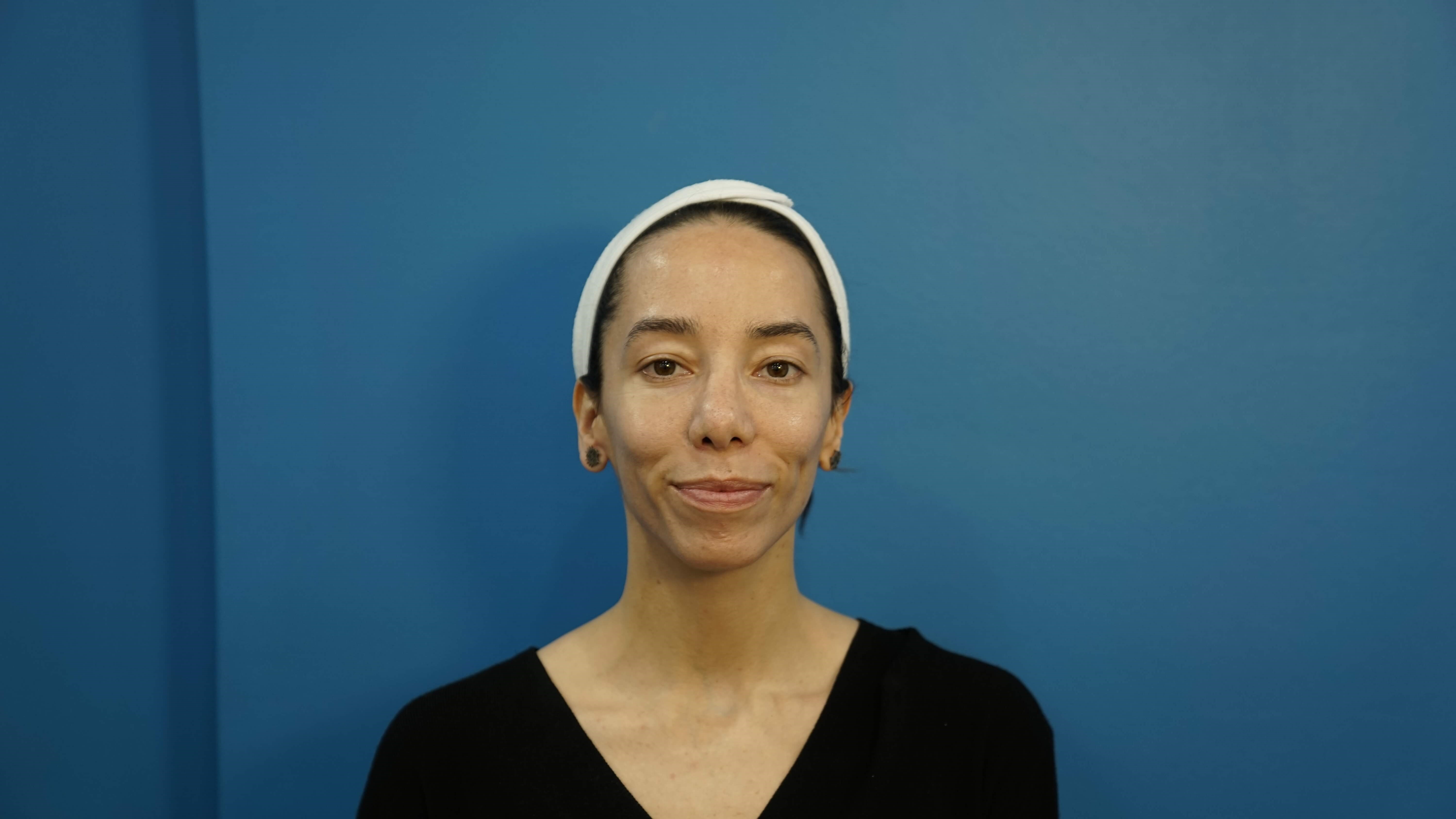 Los Angeles Rhinoplasty After