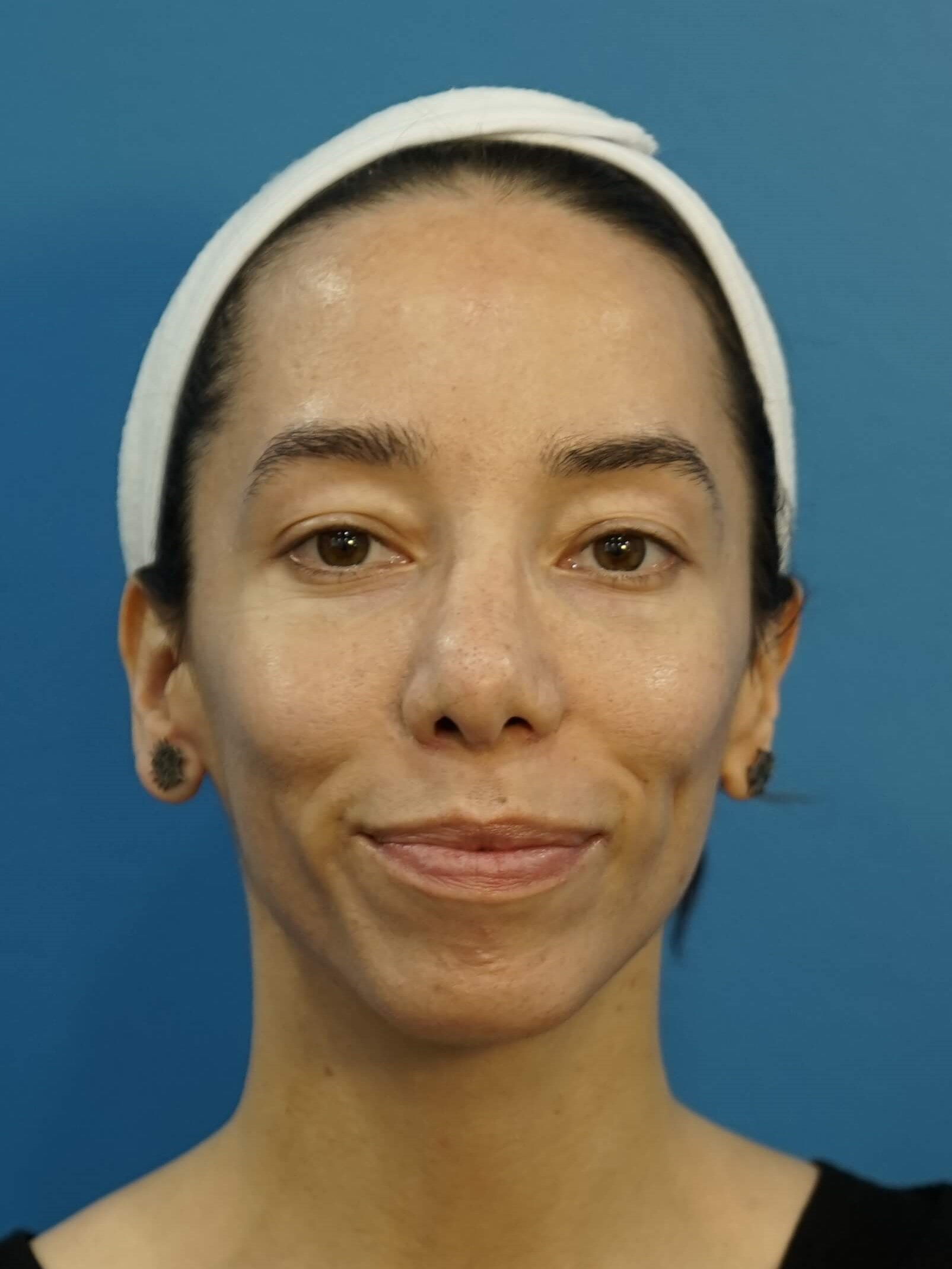 Los Angeles Rhinoplasty After