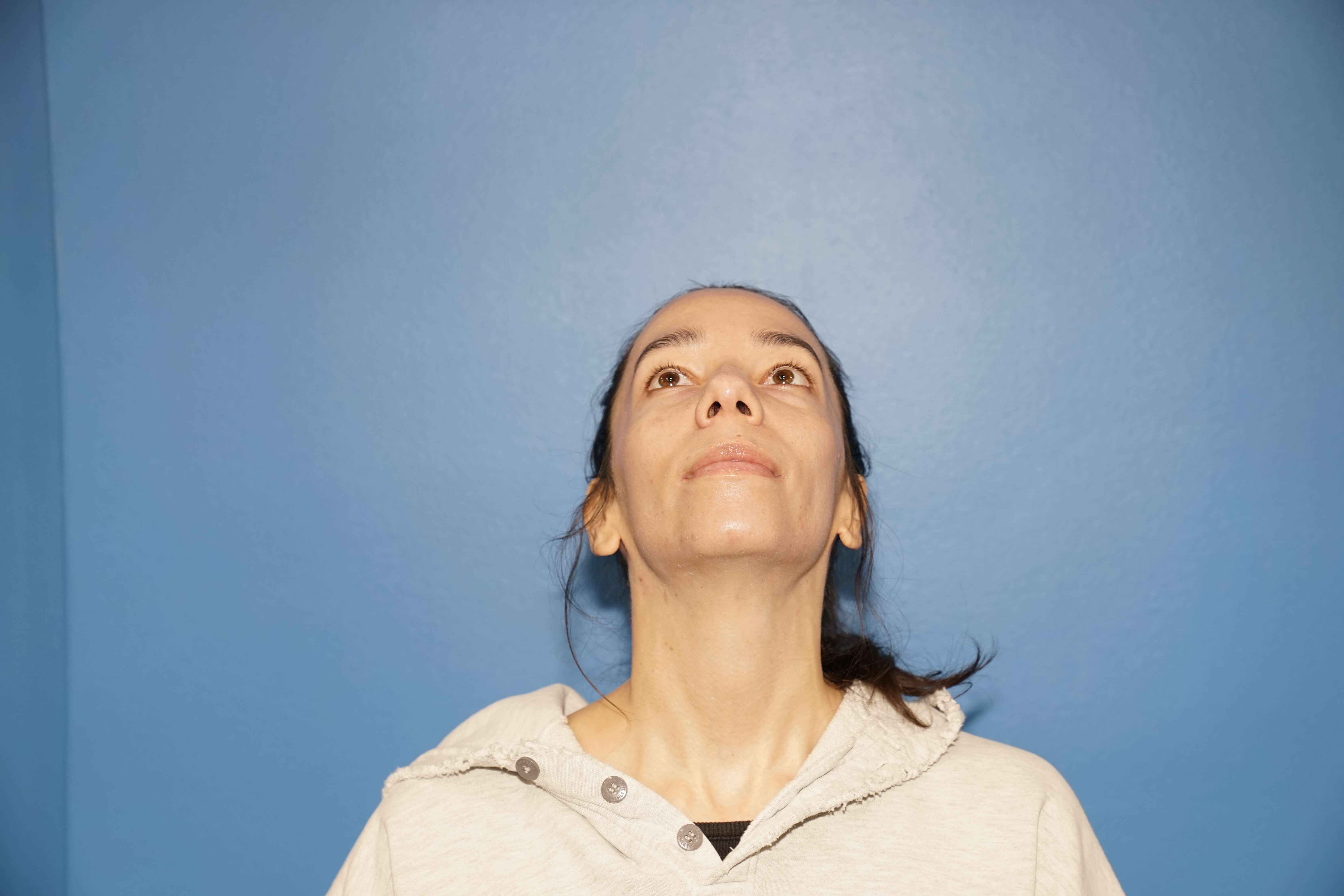 Los Angeles Rhinoplasty Before