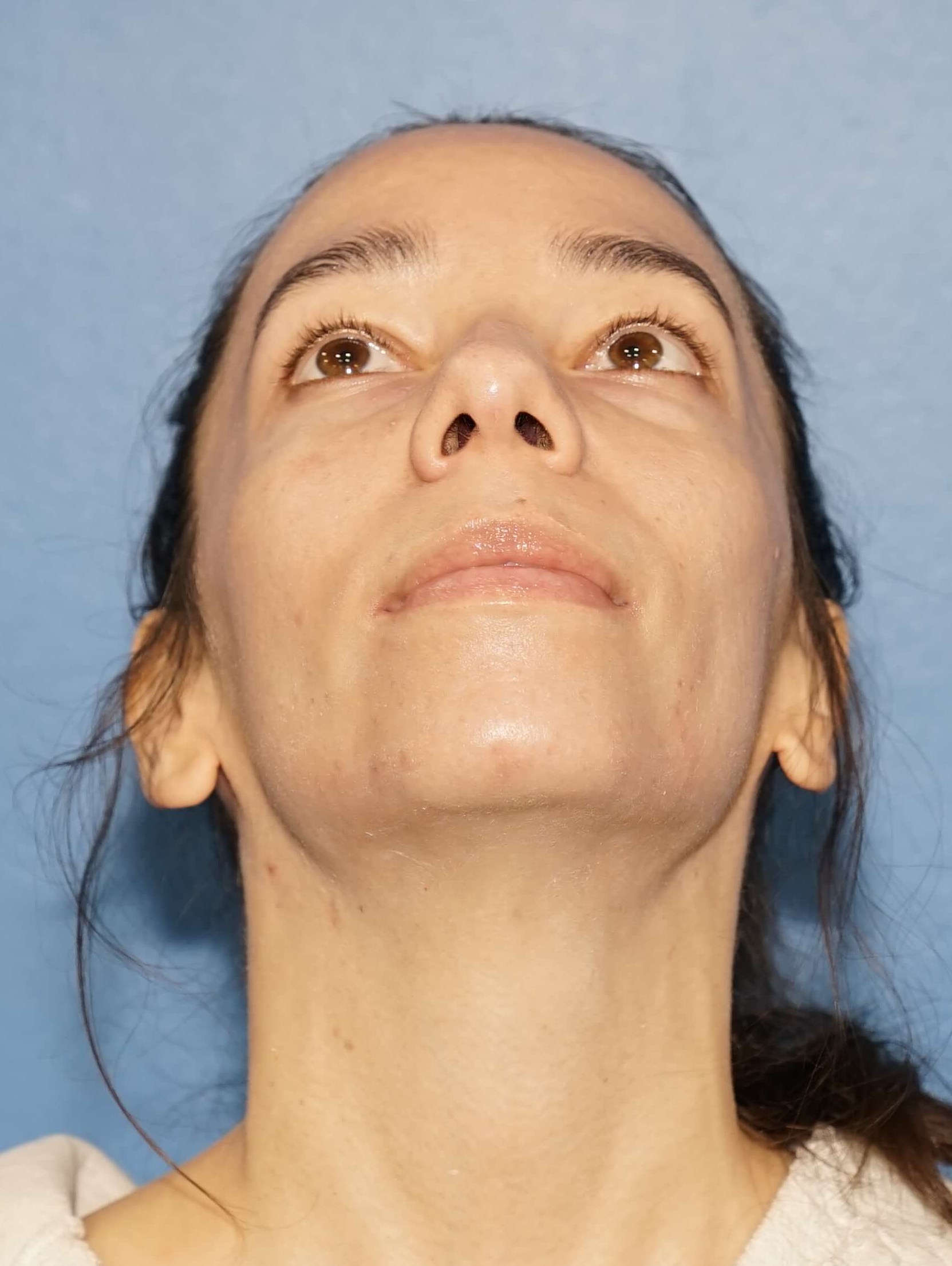 Los Angeles Rhinoplasty Before