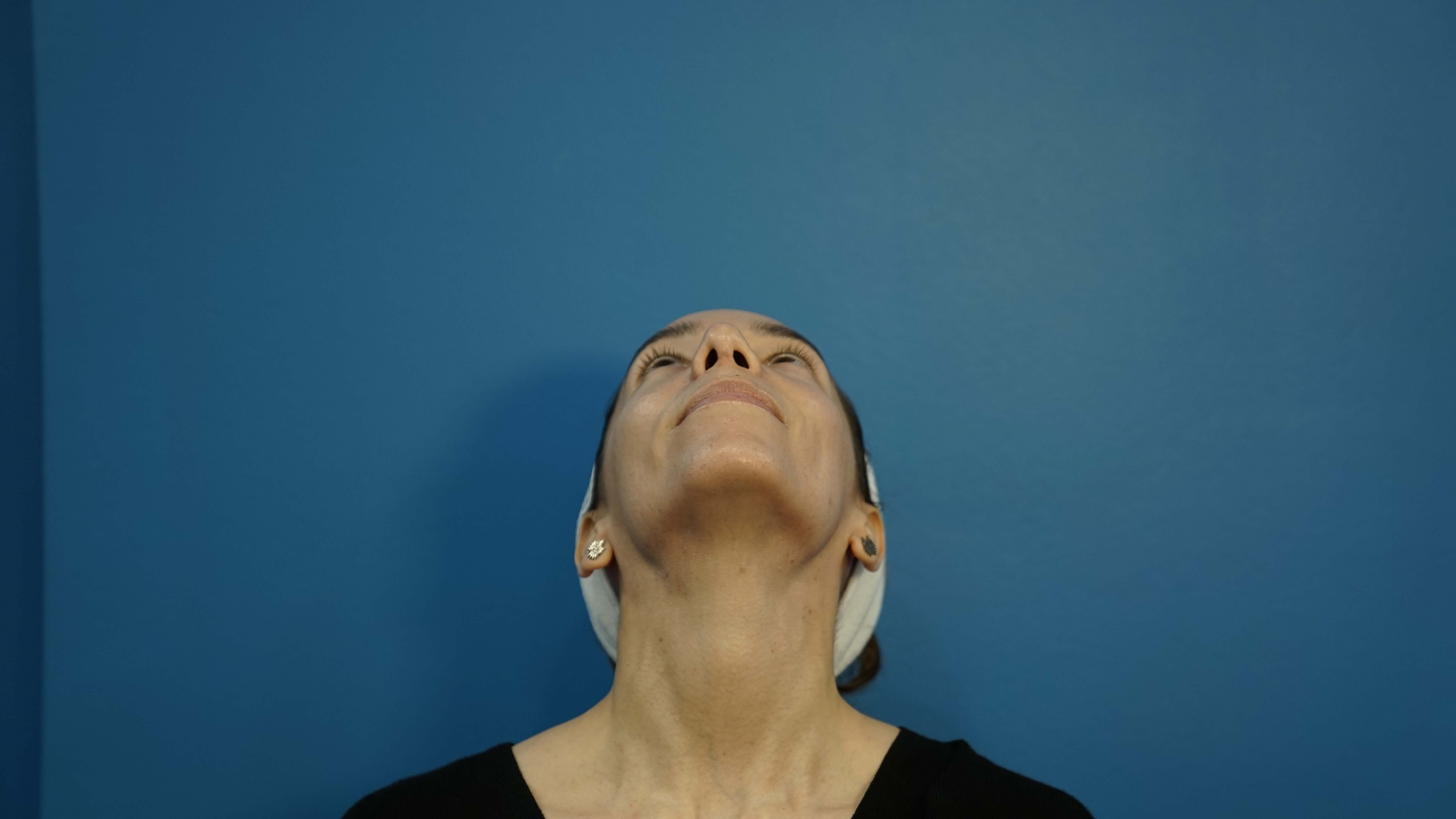 Los Angeles Rhinoplasty After
