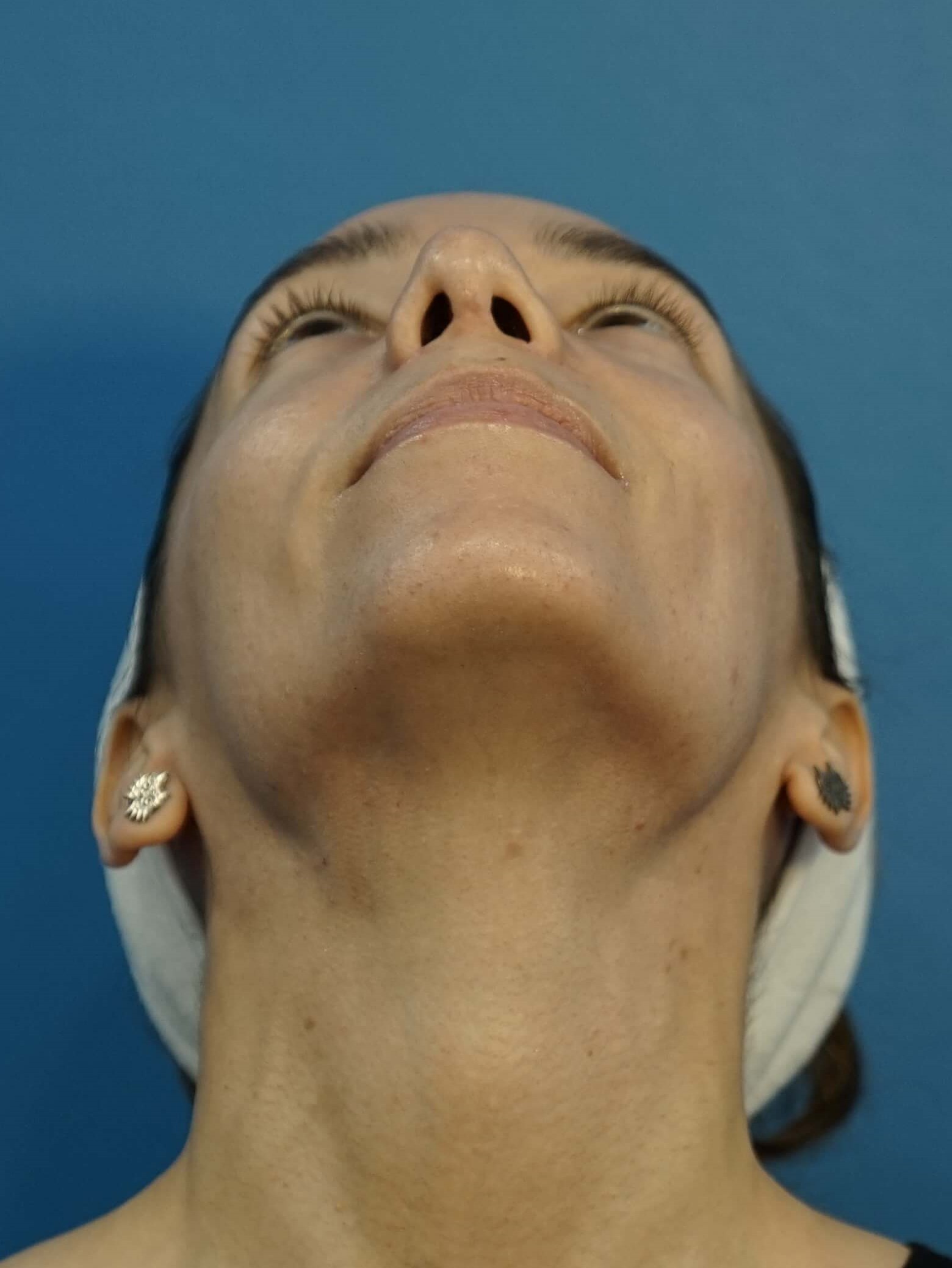Los Angeles Rhinoplasty After