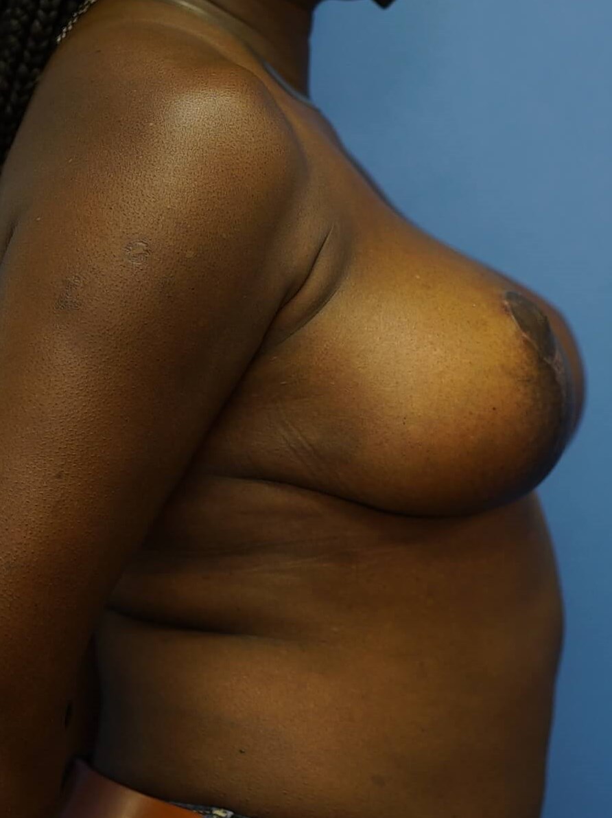Westlake Woman Has Mastopexy After