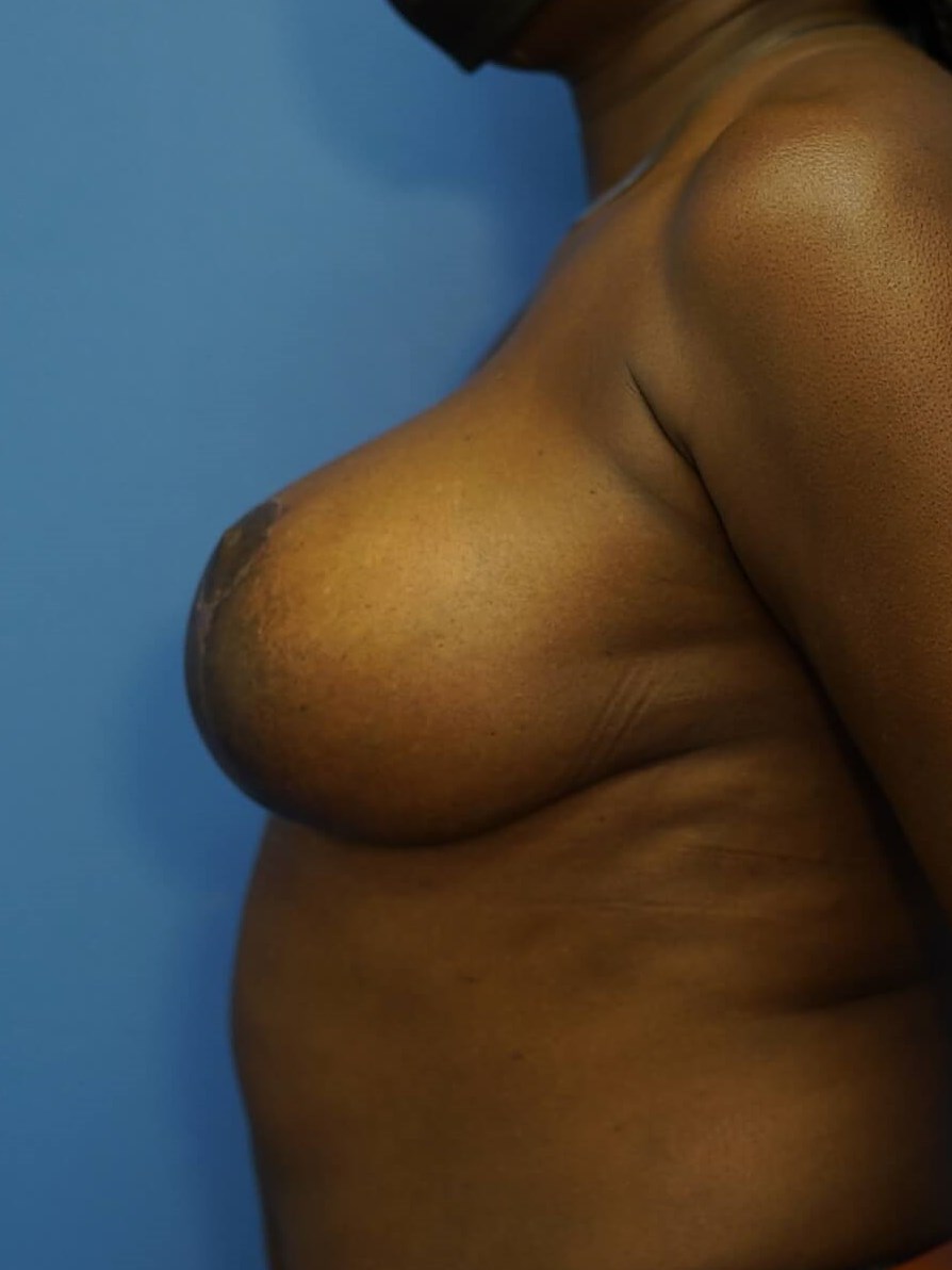 Westlake Woman Has Mastopexy After