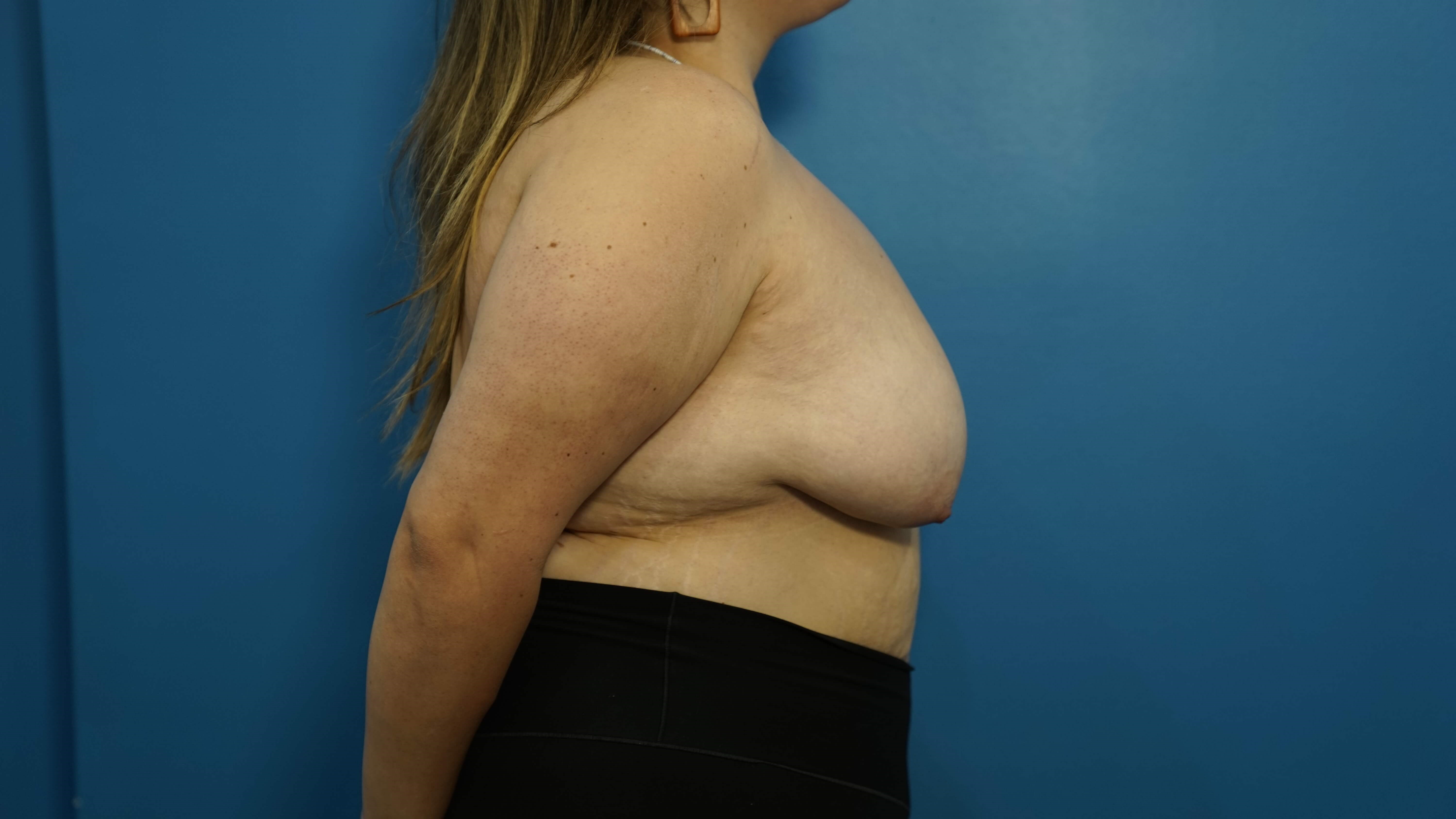 Woman has Breast Lift Before