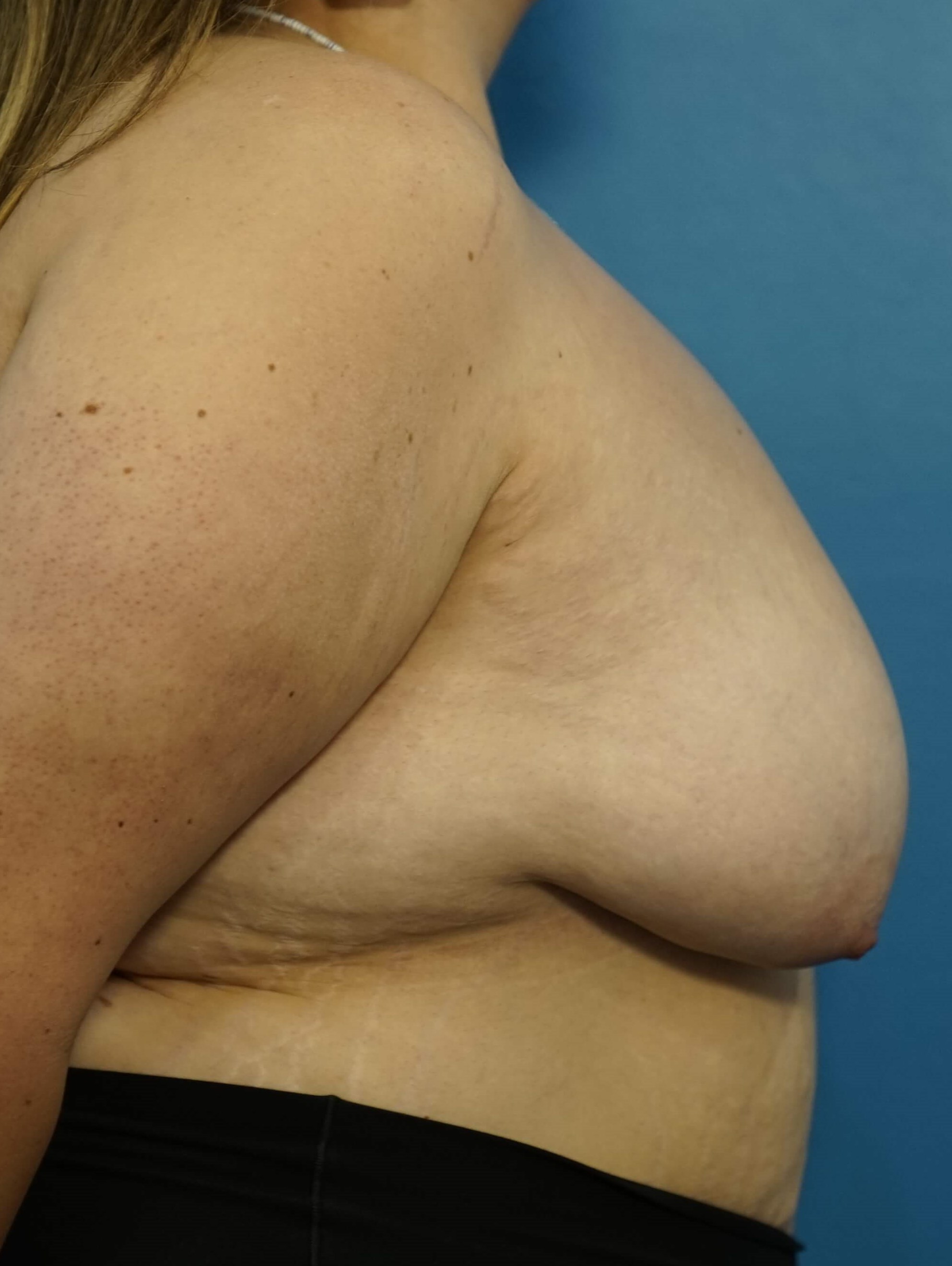 Woman has Breast Lift Before