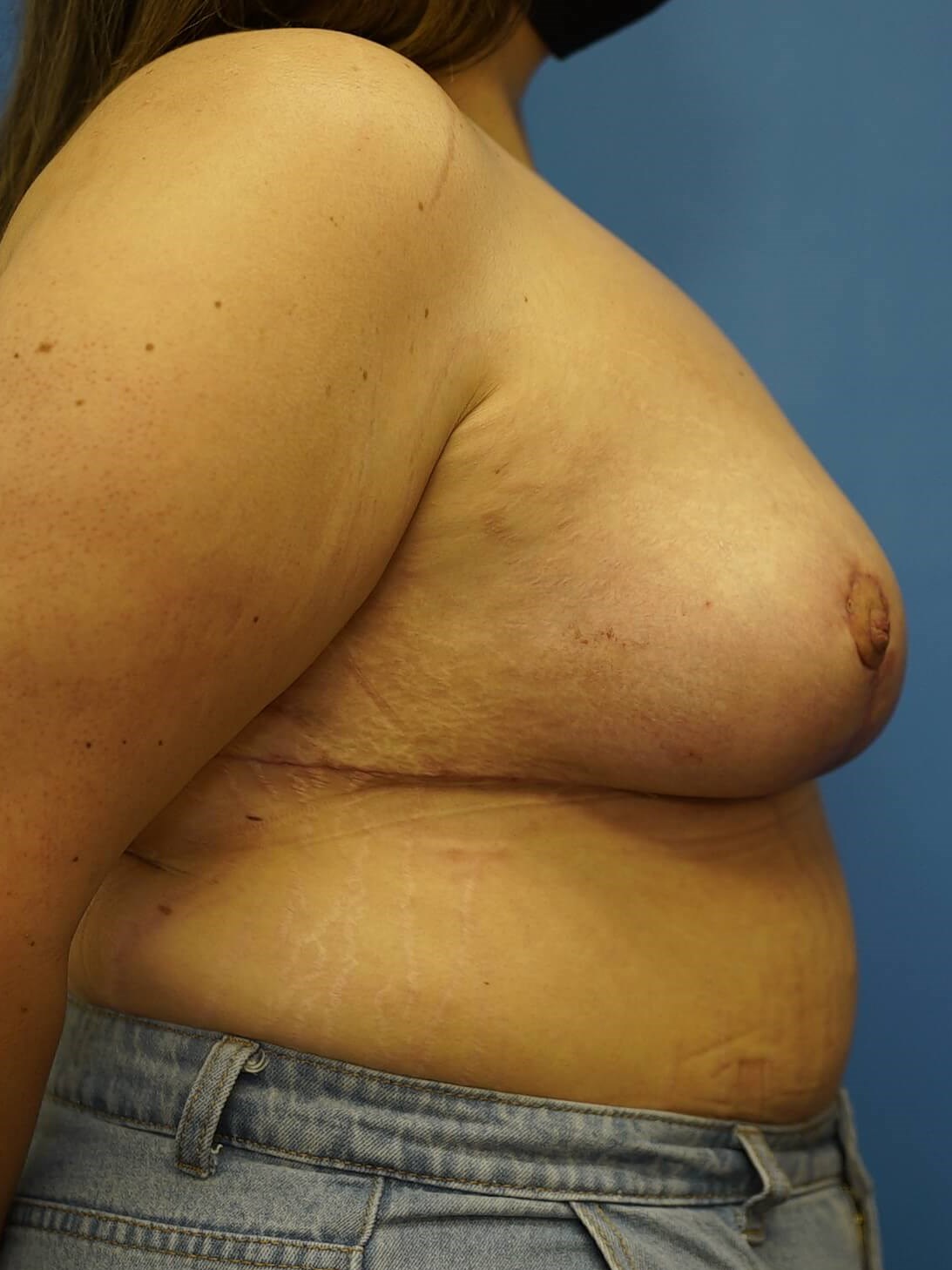 Woman has Breast Lift After