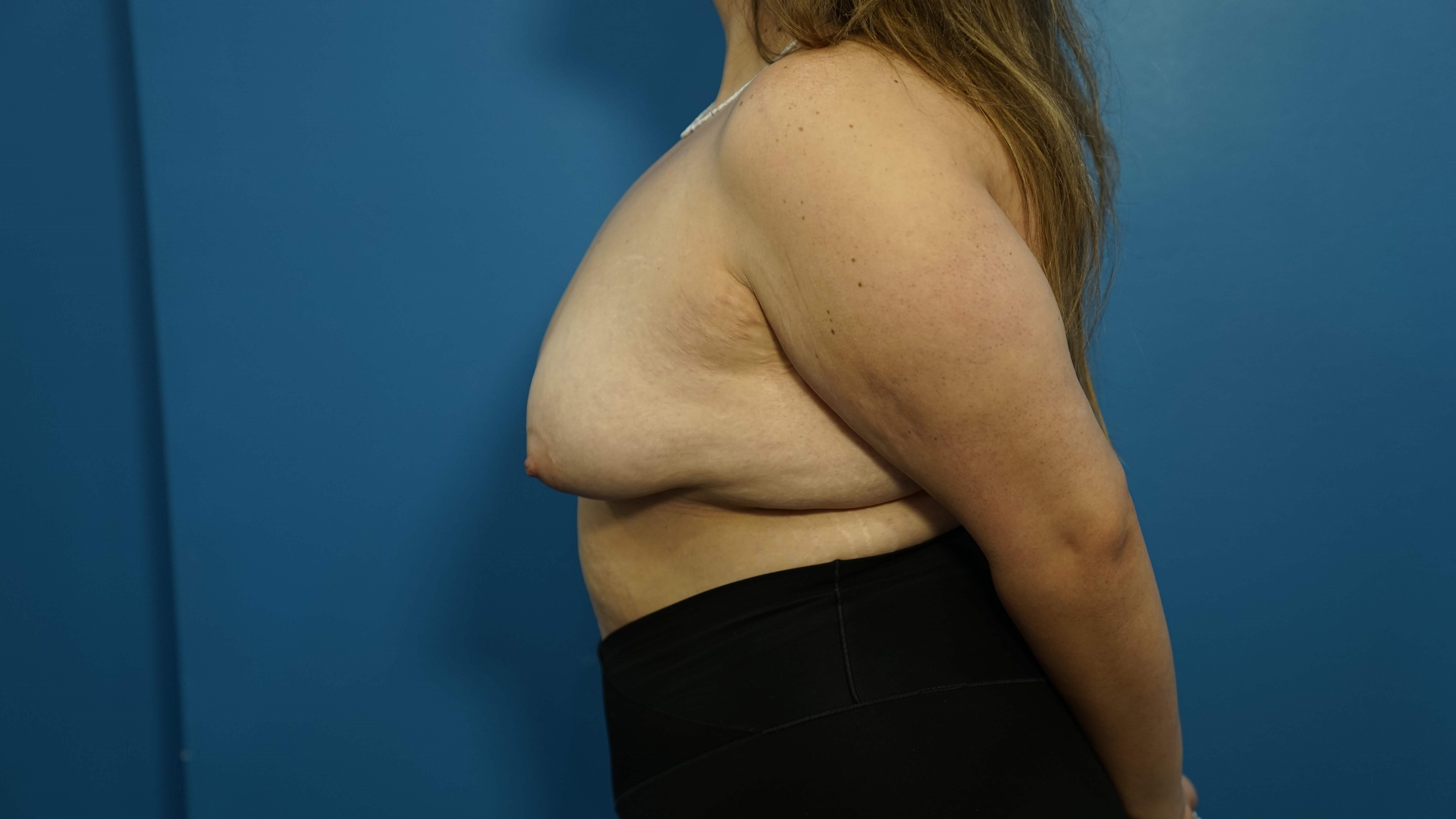 Woman has Breast Lift Before