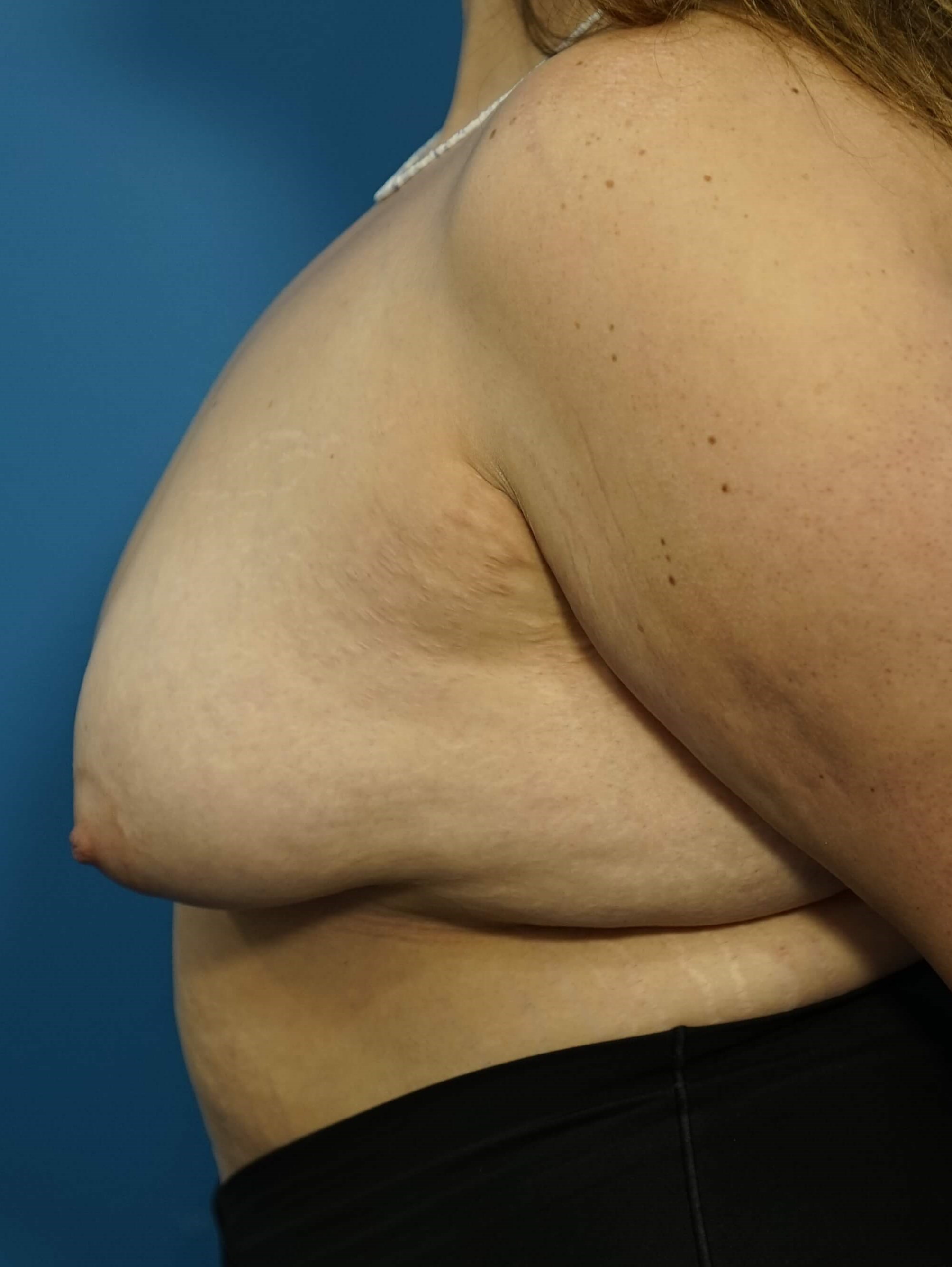 Woman has Breast Lift Before